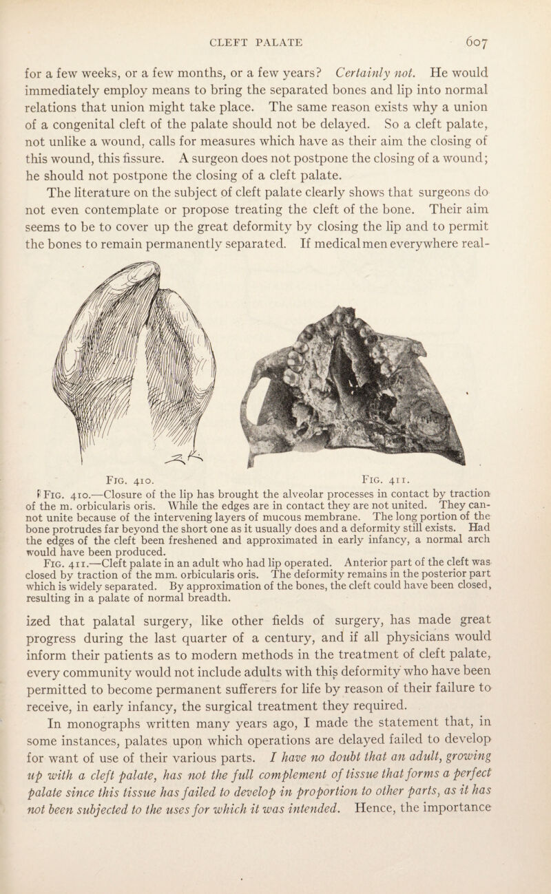 for a few weeks, or a few months, or a few years? Certainly not. He would immediately employ means to bring the separated bones and lip into normal relations that union might take place. The same reason exists why a union of a congenital cleft of the palate should not be delayed. So a cleft palate, not unlike a wound, calls for measures which have as their aim the closing of this wound, this fissure. A surgeon does not postpone the closing of a wound; he should not postpone the closing of a cleft palate. The literature on the subject of cleft palate clearly shows that surgeons do not even contemplate or propose treating the cleft of the bone. Their aim seems to be to cover up the great deformity by closing the lip and to permit the bones to remain permanently separated. If medical men everywhere real- Fjg. 410. Fig. 411. P Fig. 410.—Closure of the lip has brought the alveolar processes in contact by traction of the m. orbicularis oris. While the edges are in contact they are not united. They can¬ not unite because of the intervening layers of mucous membrane. The long portion of the bone protrudes far beyond the short one as it usually does and a deformity still exists. Had the edges of the cleft been freshened and approximated in early infancy, a normal arch would have been produced. Fig. 4 i 1.—Cleft palate in an adult who had lip operated. Anterior part of the cleft was closed by traction of the mm. orbicularis oris. The deformity remains in the posterior part which is widely separated. By approximation of the bones, the cleft could have been closed, resulting in a palate of normal breadth. ized that palatal surgery, like other fields of surgery, has made great progress during the last quarter of a century, and if all physicians would inform their patients as to modern methods in the treatment of cleft palate, every community would not include adults with this deformity who have been permitted to become permanent sufferers for life by reason of their failure to receive, in early infancy, the surgical treatment they required. In monographs written many years ago, I made the statement that, in some instances, palates upon which operations are delayed failed to develop for want of use of their various parts. I have no doubt that an adult, growing up with a cleft palate, has not the full complement of tissue that forms a perfect palate since this tissue has failed to develop in proportion to other parts, as it has not been subjected to the uses for which it was intended. Hence, the importance