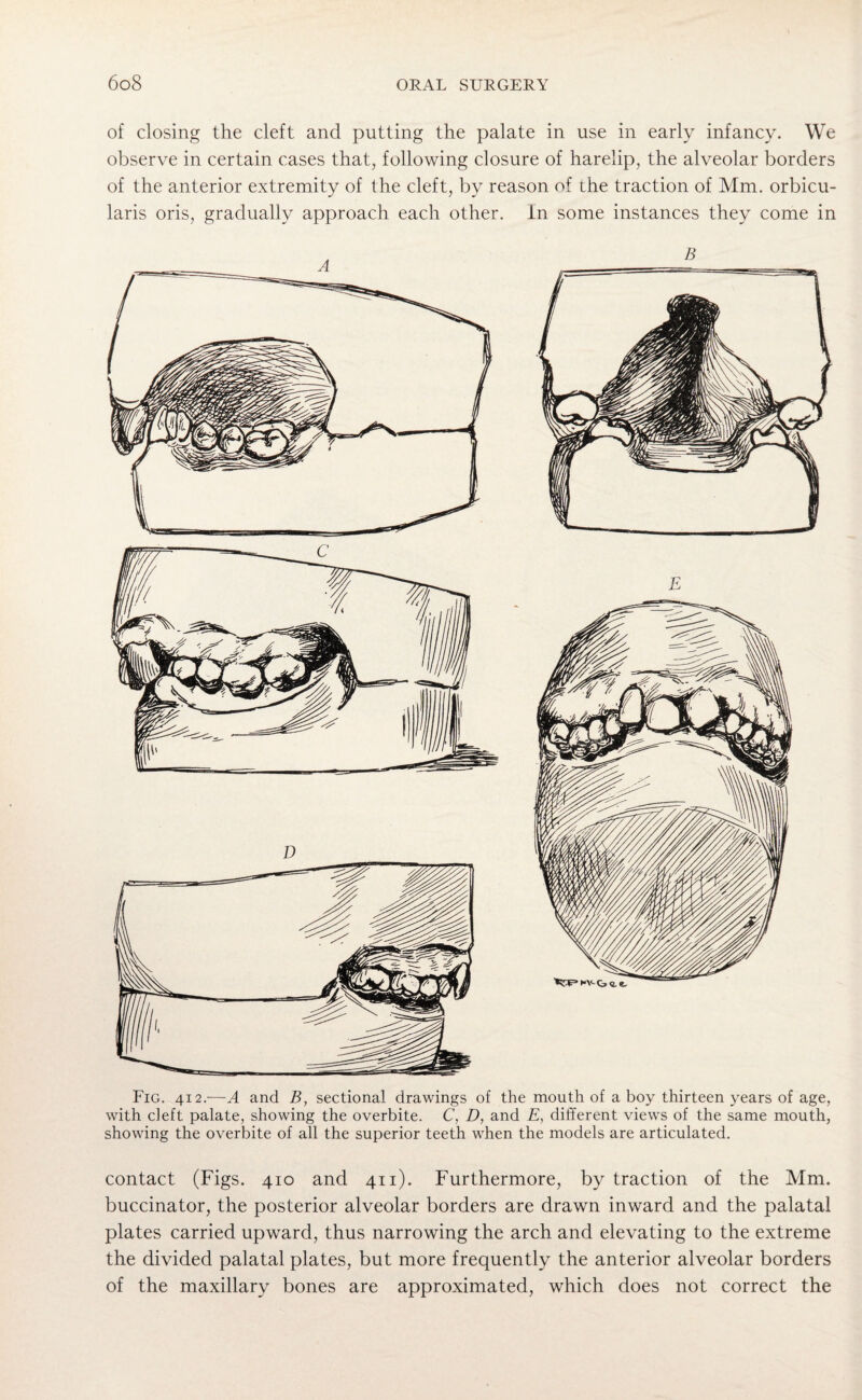 of closing the cleft and putting the palate in use in early infancy. We observe in certain cases that, following closure of harelip, the alveolar borders of the anterior extremity of the cleft, by reason of ihe traction of Mm. orbicu¬ laris oris, gradually approach each other, in some instances they come in Fig. 412.—A and B, sectional drawings of the mouth of a boy thirteen years of age, with deft palate, showing the overbite. C, D, and E, different views of the same mouth, showing the overbite of all the superior teeth when the models are articulated. contact (Figs. 410 and 411). Furthermore, by traction of the Mm. buccinator, the posterior alveolar borders are drawn inward and the palatal plates carried upward, thus narrowing the arch and elevating to the extreme the divided palatal plates, but more frequently the anterior alveolar borders of the maxillary bones are approximated, which does not correct the