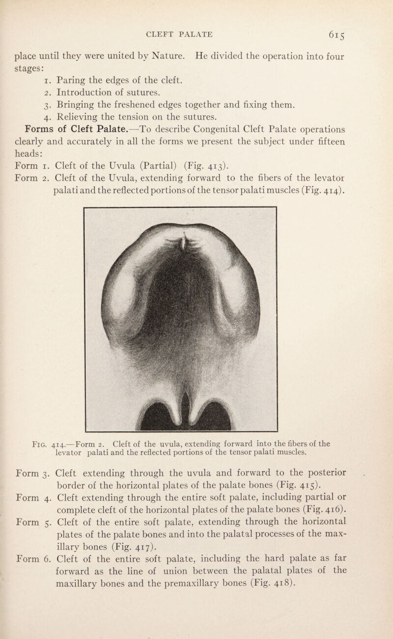 place until they were united by Nature. He divided the operation into four stages: 1. Paring the edges of the cleft. 2. Introduction of sutures. 3. Bringing the freshened edges together and fixing them. 4. Relieving the tension on the sutures. Forms of Cleft Palate.—To describe Congenital Cleft Palate operations clearly and accurately in all the forms we present the subject under fifteen heads: Form 1. Cleft of the Uvula (Partial) (Fig. 413). Form 2. Cleft of the Uvula, extending forward to the fibers of the levator palati and the reflected portions of the tensor palati muscles (Fig. 414). Fig. 414.—Form 2. Cleft of the uvula, extending forward into the fibers of the levator palati and the reflected portions of the tensor palati muscles. Form 3. Cleft extending through the uvula and forward to the posterior border of the horizontal plates of the palate bones (Fig. 415). Form 4. Cleft extending through the entire soft palate, including partial or complete cleft of the horizontal plates of the palate bones (Fig. 416). Form 5. Cleft of the entire soft palate, extending through the horizontal plates of the palate bones and into the palatal processes of the max¬ illary bones (Fig. 417). Form 6. Cleft of the entire soft palate, including the hard palate as far forward as the line of union between the palatal plates of the maxillary bones and the premaxillary bones (Fig. 418).