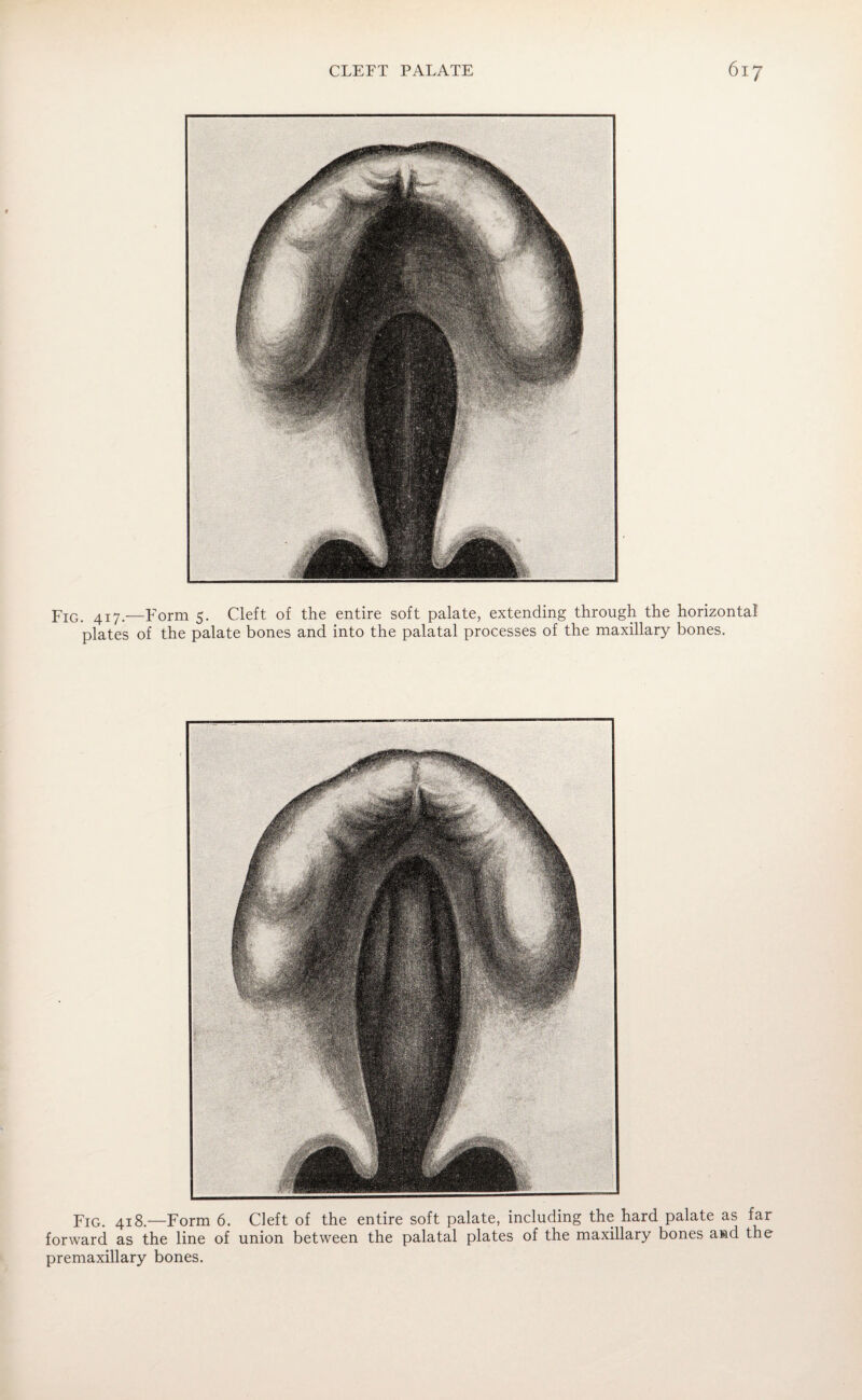 Fig. 4i7>—Form 5. Cleft of the entire soft palate, extending through the horizontal plates of the palate bones and into the palatal processes of the maxillary bones. Fig. 418.—Form 6. Cleft of the entire soft palate, including the hard palate as far forward as the line of union between the palatal plates of the maxillary bones a»d the premaxillary bones.