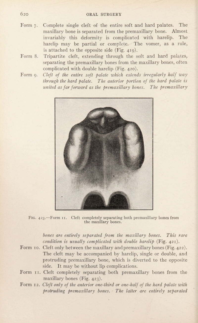 Form 7. Complete single cleft of the entire soft and hard palates. The maxillary bone is separated from the premaxillary bone. Almost invariably this deformity is complicated with harelip. The harelip may be partial or complete. The vomer, as a rule, is attached to the opposite side (Fig. 419). Form 8. Tripartite cleft, extending through the soft and hard palates, separating the premaxillary bones from the maxillary bones, often complicated with double harelip (Fig. 420). Form 9. Cleft of the entire soft palate which extends irregularly half way through the hard palate. The anterior portion of the hard palate is united as far forward as the premaxillary bones. The premaxillary Fig. 423.—Form n. Cleft completely separating both premaxillary bones from the maxillary bones. bones are entirely separated from the maxillary bones. This rare condition is usually complicated with double harelip (Fig. 421). Form 10. Cleft only between the maxillary and premaxillary bones (Fig. 422). The cleft may be accompanied by harelip, single or double, and protruding premaxillary bone, which is diverted to the opposite side. It may be without lip complications. Form 11. Cleft completely separating both premaxillary bones from the maxillary bones (Fig. 423). Form 12. Cleft only of the anterior one-third or one-half of the hard palate with protruding premaxillary bones. The latter are entirely separated