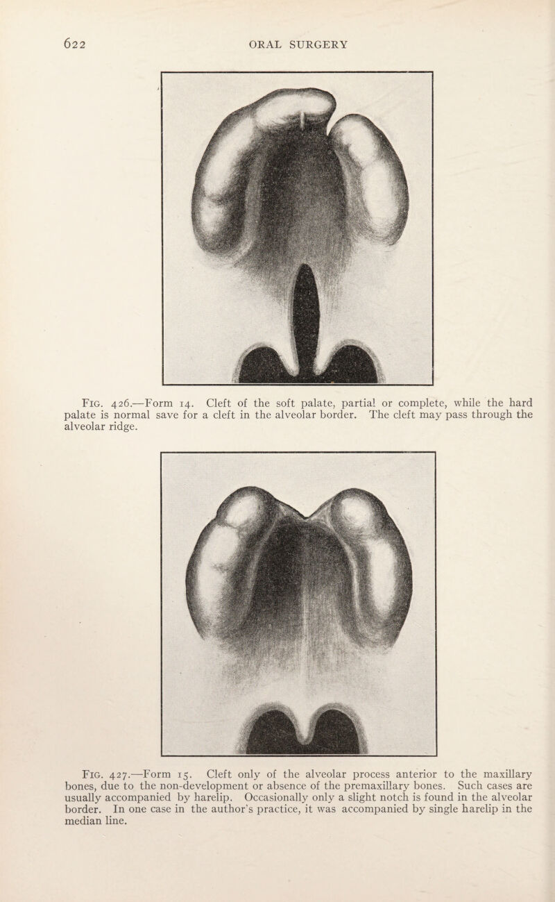 Fig. 426.—Form 14. Cleft of the soft palate, partial or complete, while the hard palate is normal save for a cleft in the alveolar border. The cleft may pass through the alveolar ridge. Fig. 427.—Form 15. Cleft only of the alveolar process anterior to the maxillary bones, due to the non-development or absence of the premaxillary bones. Such cases are usually accompanied by harelip. Occasionally only a slight notch is found in the alveolar border. In one case in the author’s practice, it was accompanied by single harelip in the median line.