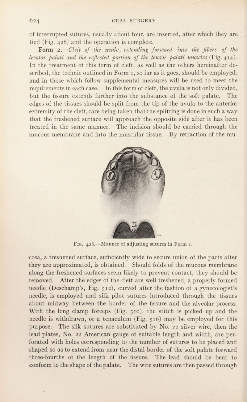 of interrupted sutures, usually about four, are inserted, after which they are tied (Fig. 428) and the operation is complete. Form 2.—Clejt of the uvula, extending forward into the fibers of the levator palati and the reflected portion of the tensor palati muscles (Fig. 414). In the treatment of this form of cleft, as well as the others hereinafter de¬ scribed, the technic outlined in Form 1, so far as it goes, should be employed; and in those which follow supplemental measures will be used to meet the requirements in each case. In this form of cleft, the uvula is not only divided, but the fissure extends farther into the substance of the soft palate. The edges of the tissues should be split from the tip of the uvula to the anterior extremity of the cleft, care being taken that the splitting is done in such a way that the freshened surface will approach the opposite side after it has been treated in the same manner. The incision should be carried through the mucous membrane and into the muscular tissue. By retraction of the mu- Fig. 428.—Manner of adjusting sutures in Form 1. cosa, a freshened surface, sufficiently wide to secure union of the parts after they are approximated, is obtained. Should folds of the mucous membrane along the freshened surfaces seem likely to prevent contact, they should be removed. After the edges of the cleft are well freshened, a properly formed needle (Deschamp’s, Fig. 512), curved after the fashion of a gynecologist’s needle, is employed and silk pilot sutures introduced through the tissues about midway between the border of the fissure and the alveolar process. With the long clamp forceps (Fig. 510), the stitch is picked up and the needle is withdrawn, or a tenaculum (Fig. 516) may be employed for this purpose. The silk sutures are substituted by No. 22 silver wire, then the lead plates, No. 22 American gauge of suitable length and width, are per¬ forated with holes corresponding to the number of sutures to be placed and shaped so as to extend from near the distal border of the soft palate forward three-fourths of the length of the fissure. The lead should be bent to conform to the shape of the palate. The wire sutures are then passed through