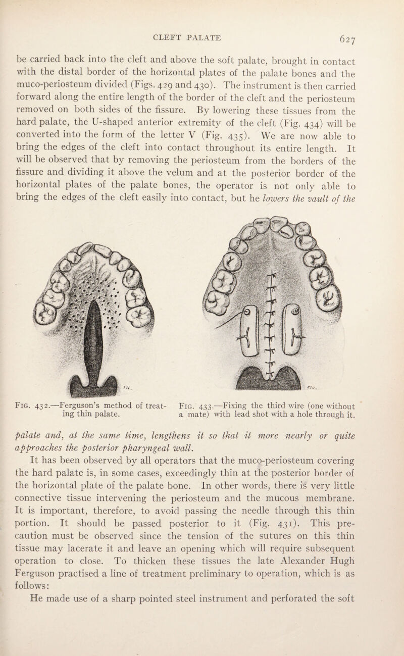 be carried back into the cleft and above the soft palate, brought in contact with the distal border of the horizontal plates of the palate bones and the muco-periosteum divided (Figs. 429 and 430). The instrument is then carried forward along the entire length of the border of the cleft and the periosteum removed on both sides of the fissure. By lowering these tissues from the hard palate, the U-shaped anterior extremity of the cleft (Fig. 434) will be converted into the form of the letter V (Fig. 435). We are now able to bring the edges of the cleft into contact throughout its entire length. It will be observed that by removing the periosteum from the borders of the fissure and dividing it above the velum and at the posterior border of the horizontal plates of the palate bones, the operator is not only able to bring the edges of the cleft easily into contact, but he lowers the vault of the Fig. 432.—Ferguson’s method of treat- Fig. 433.—Fixing the third wire (one without ing thin palate. a mate) with lead shot with a hole through it. palate and, at the same time, lengthens it so that it more nearly or quite approaches the posterior pharyngeal wall. It has been observed by all operators that the muco-periosteum covering the hard palate is, in some cases, exceedingly thin at the posterior border of the horizontal plate of the palate bone. In other words, there is very little connective tissue intervening the periosteum and the mucous membrane. It is important, therefore, to avoid passing the needle through this thin portion. It should be passed posterior to it (Fig. 431). This pre¬ caution must be observed since the tension of the sutures on this thin tissue may lacerate it and leave an opening which will require subsequent operation to close. To thicken these tissues the late Alexander Hugh Ferguson practised a line of treatment preliminary to operation, which is as follows: He made use of a sharp pointed steel instrument and perforated the soft