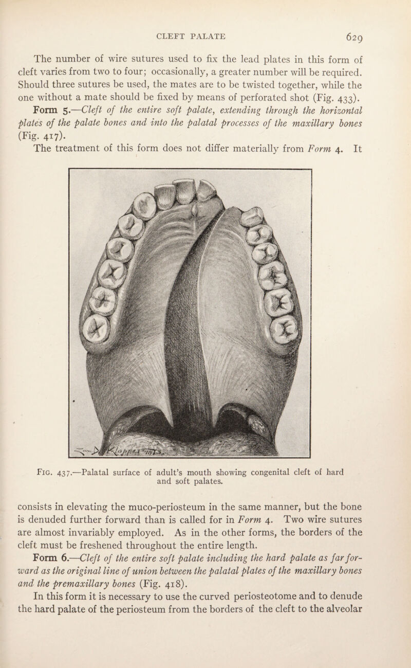 The number of wire sutures used to fix the lead plates in this form of cleft varies from two to four; occasionally, a greater number will be required. Should three sutures be used, the mates are to be twisted together, while the one without a mate should be fixed by means of perforated shot (Fig. 433). Form 5*—Cleft of the entire soft palate, extending through the horizontal plates of the palate bones and into the palatal processes of the maxillary bones (Fig- 417)- The treatment of this form does not differ materially from Form 4. It Fig. 437.—Palatal surface of adult’s mouth showing congenital cleft of hard and soft palates. consists in elevating the muco-periosteum in the same manner, but the bone is denuded further forward than is called for in Form 4. Two wire sutures are almost invariably employed. As in the other forms, the borders of the cleft must be freshened throughout the entire length. Form 6.—Cleft of the entire soft palate including the hard palate as far for¬ ward as the original line of union between the palatal plates of the maxillary bones and the premaxillary bones (Fig. 418). In this form it is necessary to use the curved periosteotome and to denude the hard palate of the periosteum from the borders of the cleft to the alveolar