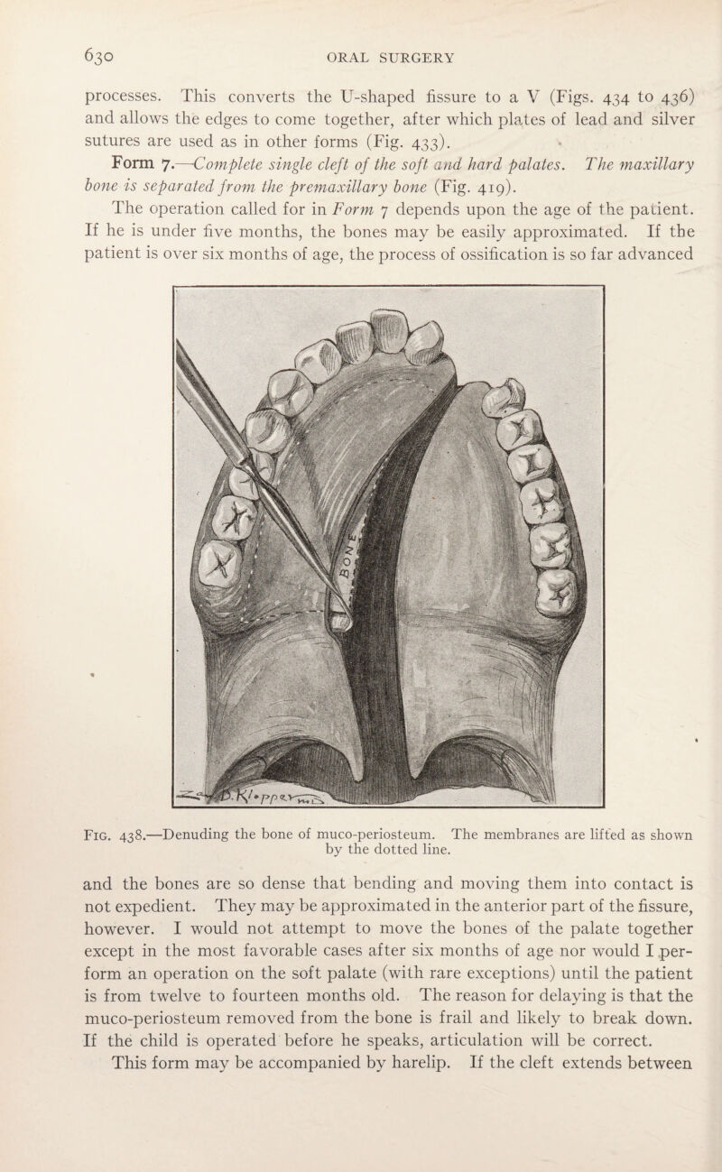 processes. This converts the U-shaped fissure to a V (Figs. 434 to 436) and allows the edges to come together, after which plates of lead and silver sutures are used as in other forms (Fig. 433). Form 7.—Complete single cleft of the soft and hard palates. The maxillary hone is separated from the premaxillary bone (Fig. 419). The operation called for in Form 7 depends upon the age of the patient. If he is under five months, the bones may be easily approximated. If the patient is over six months of age, the process of ossification is so far advanced Fig. 438.—Denuding the bone of muco-periosteum. The membranes are lifted as shown by the dotted line. and the bones are so dense that bending and moving them into contact is not expedient. They may be approximated in the anterior part of the fissure, however. I would not attempt to move the bones of the palate together except in the most favorable cases after six months of age nor would I per¬ form an operation on the soft palate (with rare exceptions) until the patient is from twelve to fourteen months old. The reason for delaying is that the muco-periosteum removed from the bone is frail and likely to break down. If the child is operated before he speaks, articulation will be correct. This form may be accompanied by harelip. If the cleft extends between