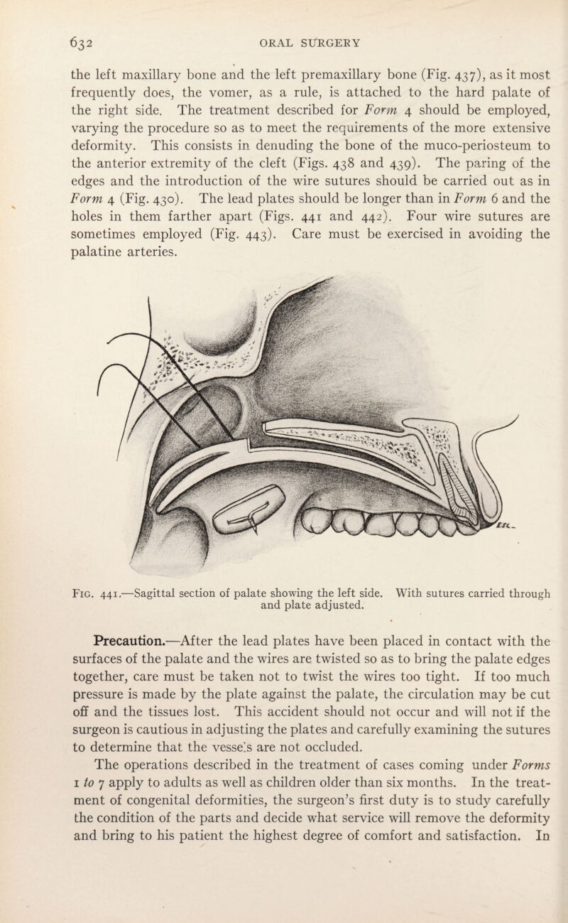 the left maxillary bone and the left premaxillary bone (Fig. 437), as it most frequently does, the vomer, as a rule, is attached to the hard palate of the right side. The treatment described for Form 4 should be employed, varying the procedure so as to meet the requirements of the more extensive deformity. This consists in denuding the bone of the muco-periosteum to the anterior extremity of the cleft (Figs. 438 and 439). The paring of the edges and the introduction of the wire sutures should be carried out as in Form 4 (Fig. 430). The lead plates should be longer than in Form 6 and the holes in them farther apart (Figs. 441 and 442). Four wire sutures are sometimes employed (Fig. 443). Care must be exercised in avoiding the palatine arteries. Fig. 441.—Sagittal section of palate showing the left side. With sutures carried through and plate adjusted. Precaution.-—After the lead plates have been placed in contact with the surfaces of the palate and the wires are twisted so as to bring the palate edges together, care must be taken not to twist the wires too tight. If too much pressure is made by the plate against the palate, the circulation may be cut off and the tissues lost. This accident should not occur and will not if the surgeon is cautious in adjusting the plates and carefully examining the sutures to determine that the vessels are not occluded. The operations described in the treatment of cases coming under Forms 1 to 7 apply to adults as well as children older than six months. In the treat¬ ment of congenital deformities, the surgeon’s first duty is to study carefully the condition of the parts and decide what service will remove the deformity and bring to his patient the highest degree of comfort and satisfaction. In