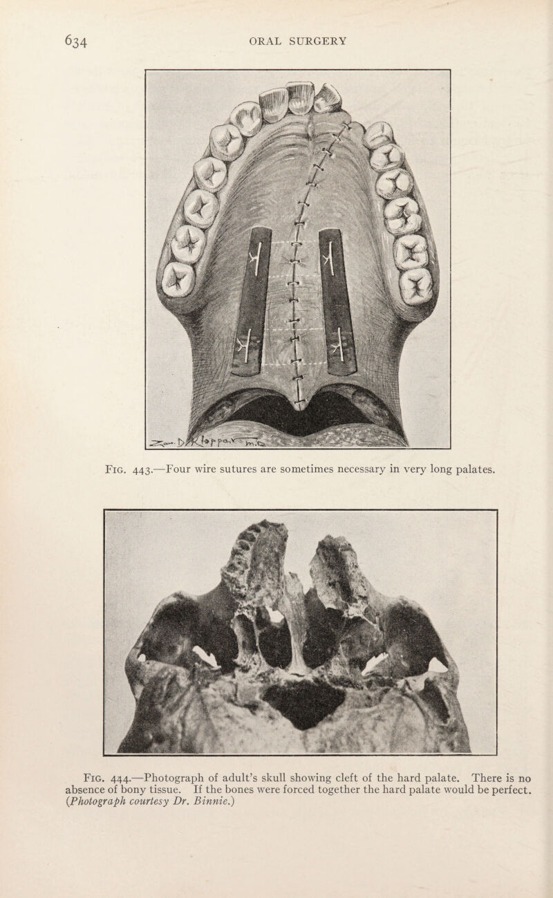 Fig. 444.—Photograph of adult’s skull showing cleft of the hard palate. There is no absence of bony tissue. If the bones were forced together the hard palate would be perfect. (Photograph courtesy Dr. Binnie.)