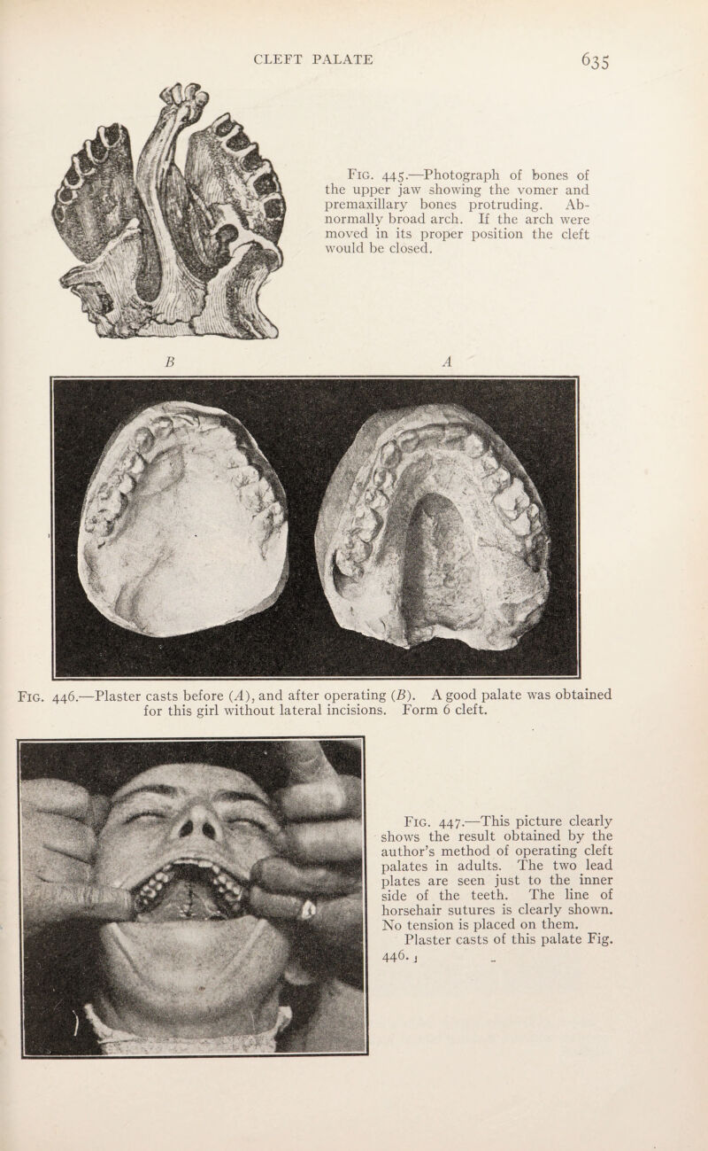 Fig. 445.—Photograph of bones of the upper jaw showing the vomer and premaxillary bones protruding. Ab¬ normally broad arch. If the arch were moved in its proper position the cleft would be closed. B A Fig. 446.—Plaster casts before (A), and after operating (B). A good palate was obtained for this girl without lateral incisions. Form 6 cleft. i Fig. 447.—This picture clearly shows the result obtained by the author’s method of operating cleft palates in adults. The two lead plates are seen just to the inner side of the teeth. The line of horsehair sutures is clearly shown. No tension is placed on them. Plaster casts of this palate Fig. 446. 1