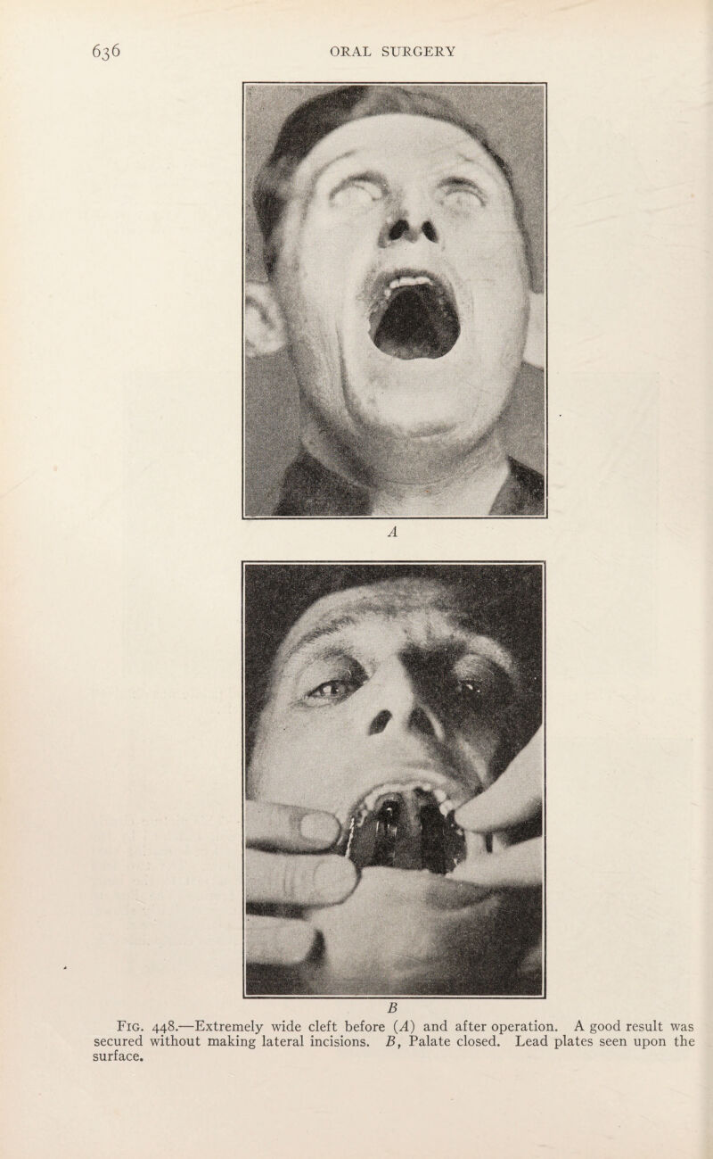 B Fig. 448.—Extremely wide cleft before (A) and after operation. A good result was secured without making lateral incisions. B, Palate closed. Lead plates seen upon the surface.