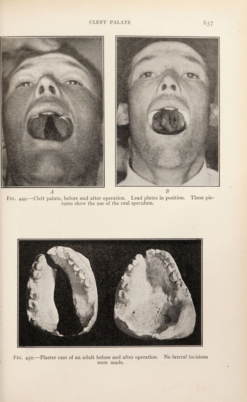 Fig. 449 A B Cleft palate, before and after operation. Lead plates in position, tures show the use of the oral speculum. These pic- Fig. 450.—Plaster cast of an adult before and after operation. No lateral incisions were made.