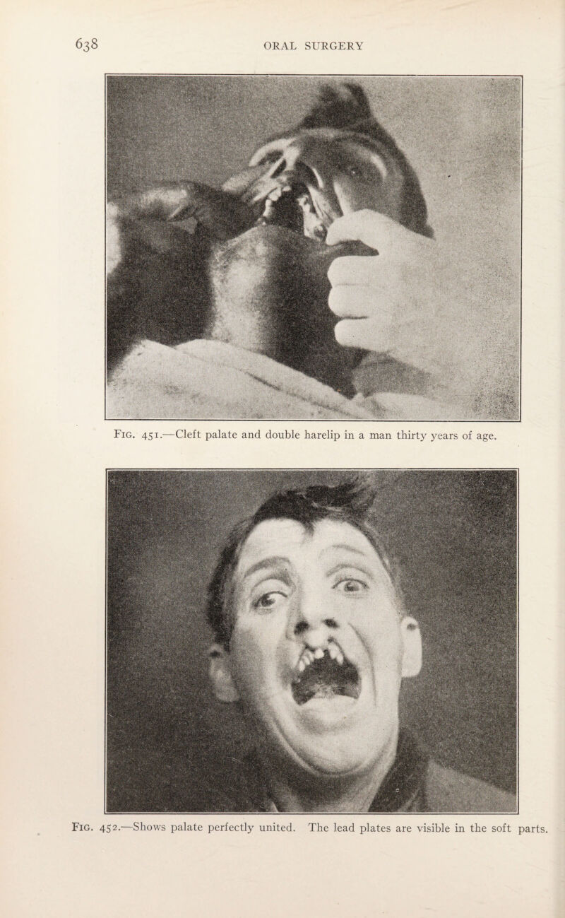 Fig. 451.—Cleft palate and double harelip in a man thirty years of age. Fig. 452.—Shows palate perfectly united. The lead plates are visible in the soft parts.