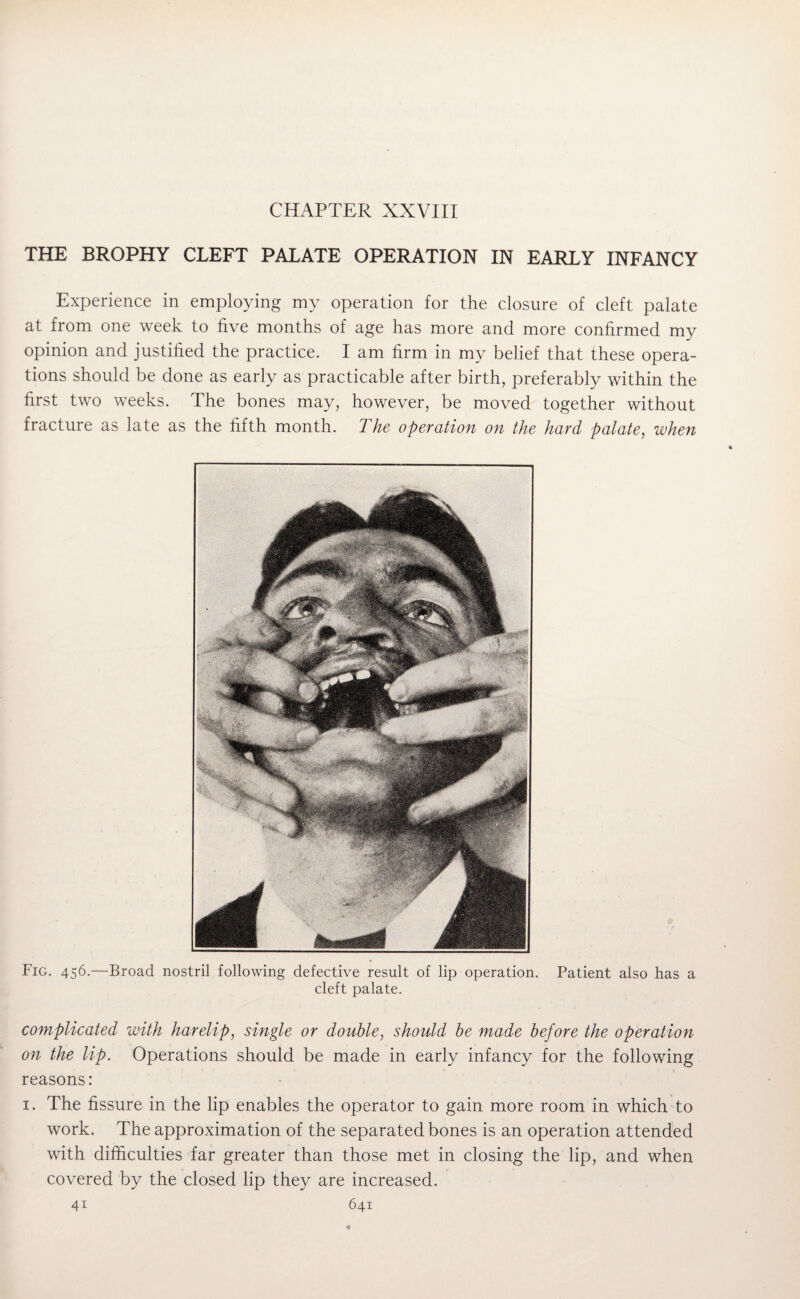 CHAPTER XXVIII THE BROPHY CLEFT PALATE OPERATION IN EARLY INFANCY Experience in employing my operation for the closure of cleft palate at from one week to five months of age has more and more confirmed my opinion and justified the practice. I am firm in my belief that these opera¬ tions should be done as early as practicable after birth, preferably within the first two weeks. The bones may, however, be moved together without fracture as late as the fifth month. The operation on the hard palate, when Fig. 456.—Broad nostril following defective result of lip operation. Patient also has a cleft palate. complicated with harelip, single or double, should be made before the operation on the lip. Operations should be made in early infancy for the following reasons: 1. The fissure in the lip enables the operator to gain more room in which to work. The approximation of the separated bones is an operation attended with difficulties far greater than those met in closing the lip, and when covered by the closed lip they are increased.
