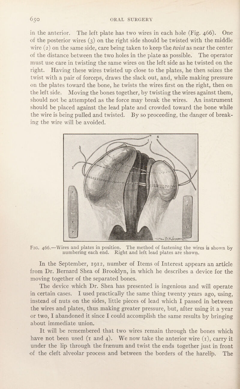 in the anterior. The left plate has two wires in each hole (Fig. 466). One of the posterior wires (3) on the right side should be twisted with the middle wire (2) on the same side, care being taken to keep the twist as near the center of the distance between the two holes in the plate as possible. The operator must use care in twisting the same wires on the left side as he twisted on the right. Having these wires twisted up close to the plates, he then seizes the twist with a pair of forceps, draws the slack out, and, while making pressure on the plates toward the bone, he twists the wires first on the right, then on the left side. Moving the bones together, by twisting the wires against them, should not be attempted as the force may break the wires. An instrument should be placed against the lead plate and crowded toward the bone while the wire is being pulled and twisted. By so proceeding, the danger of break¬ ing the wire will be avoided. Fig. 466.—Wires and plates in position. The method of fastening the wires is shown by numbering each end. Right and left lead plates are shown. In the September, 1912, number of Items of Interest appears an article from Dr. Bernard Shea of Brooklyn, in which he describes a device for the moving together of the separated bones. The device which Dr. Shea has presented is ingenious and will operate in certain cases. I used practically the same thing twenty years ago, using, instead of nuts on the sides, little pieces of lead which I passed in between the wires and plates, thus making greater pressure, but, after using it a year or two, I abandoned it since I could accomplish the same results by bringing about immediate union. It will be remembered that two wires remain through the bones which have not been used (1 and 4). We now take the anterior wire (1), carry it under the lip through the frsenum and twist the ends together just in front of the cleft alveolar process and between the borders of the harelip. The