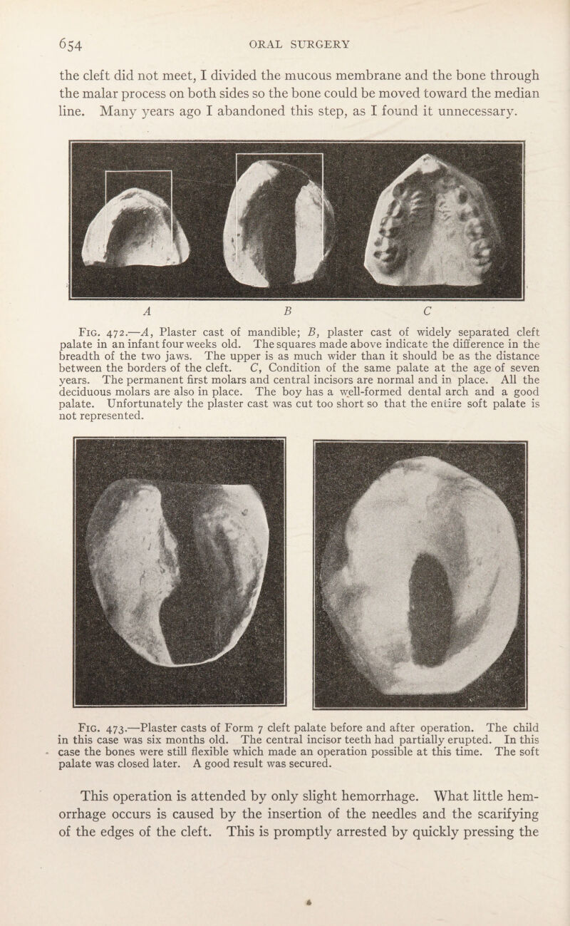 the cleft did not meet, I divided the mucous membrane and the bone through the malar process on both sides so the bone could be moved toward the median line. Many years ago I abandoned this step, as I found it unnecessary. ABC Fig. 472.—A, Plaster cast of mandible; B, plaster cast of widely separated cleft palate in an infant four weeks old. The squares made above indicate the difference in the breadth of the two jaws. The upper is as much wider than it should be as the distance between the borders of the cleft. C, Condition of the same palate at the age of seven years. The permanent first molars and central incisors are normal and in place. All the deciduous molars are also in place. The boy has a well-formed dental arch and a good palate. Unfortunately the plaster cast was cut too short so that the entire soft palate is not represented. Fig. 473.—Plaster casts of Form 7 cleft palate before and after operation. The child in this case was six months old. The central incisor teeth had partially erupted. In this case the bones were still flexible which made an operation possible at this time. The soft palate was closed later. A good result was secured. This operation is attended by only slight hemorrhage. What little hem¬ orrhage occurs is caused by the insertion of the needles and the scarifying of the edges of the cleft. This is promptly arrested by quickly pressing the