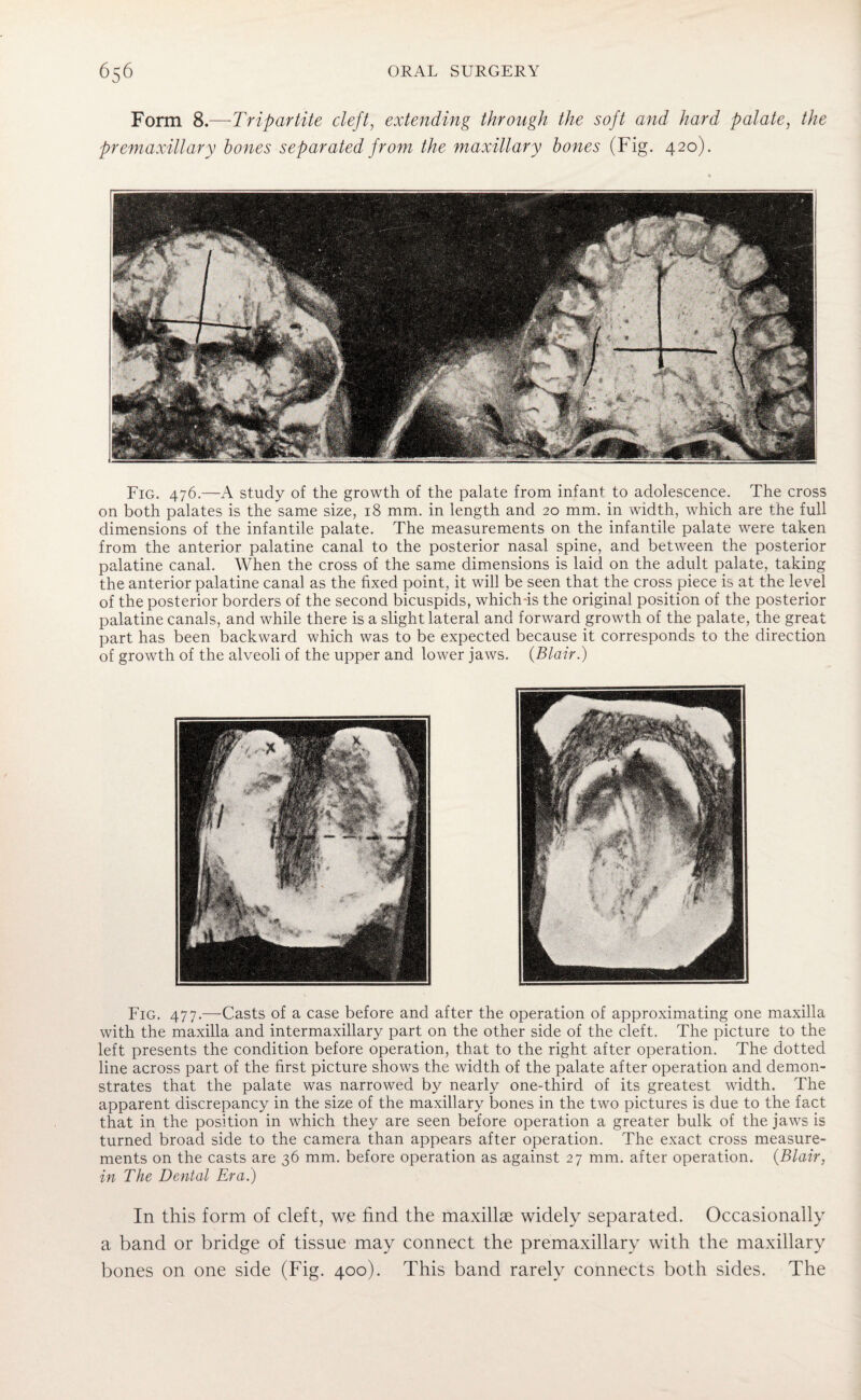 Form 8.—Tripartite cleft, extending through the soft and hard palate, the premaxillary hones separated from the maxillary hones (Fig. 420). Fig. 476.—A study of the growth of the palate from infant to adolescence. The cross on both palates is the same size, 18 mm. in length and 20 mm. in width, which are the full dimensions of the infantile palate. The measurements on the infantile palate were taken from the anterior palatine canal to the posterior nasal spine, and between the posterior palatine canal. When the cross of the same dimensions is laid on the adult palate, taking the anterior palatine canal as the fixed point, it will be seen that the cross piece is at the level of the posterior borders of the second bicuspids, which-is the original position of the posterior palatine canals, and while there is a slight lateral and forward growth of the palate, the great part has been backward which was to be expected because it corresponds to the direction of growth of the alveoli of the upper and lower jaws. {Blair.) Fig. 477.—Casts of a case before and after the operation of approximating one maxilla with the maxilla and intermaxillary part on the other side of the cleft. The picture to the left presents the condition before operation, that to the right after operation. The dotted line across part of the first picture shows the width of the palate after operation and demon¬ strates that the palate was narrowed by nearly one-third of its greatest width. The apparent discrepancy in the size of the maxillary bones in the two pictures is due to the fact that in the position in which they are seen before operation a greater bulk of the jaws is turned broad side to the camera than appears after operation. The exact cross measure¬ ments on the casts are 36 mm. before operation as against 27 mm. after operation. {Blair, in The Dental Era.) In this form of cleft, we find the maxillae widely separated. Occasionally a band or bridge of tissue may connect the premaxillary with the maxillary bones on one side (Fig. 400). This band rarely connects both sides. The