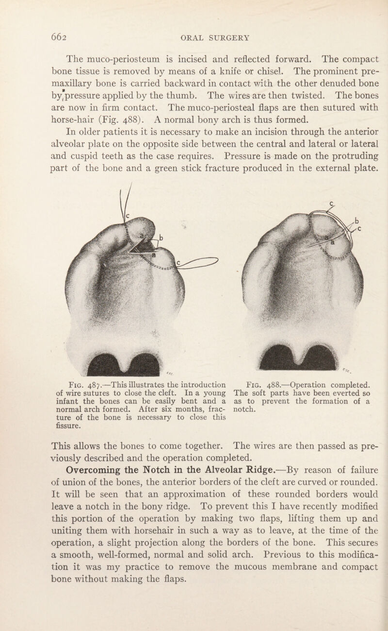 The muco-periosteum is incised and reflected forward. The compact bone tissue is removed by means of a knife or chisel. The prominent pre¬ maxillary bone is carried backward in contact with the other denuded bone byt pressure applied by the thumb. The wires are then twisted. The bones are now in firm contact. The muco-periosteal flaps are then sutured with horse-hair (Fig. 488). A normal bony arch is thus formed. In older patients it is necessary to make an incision through the anterior alveolar plate on the opposite side between the central and lateral or lateral and cuspid teeth as the case requires. Pressure is made on the protruding part of the bone and a green stick fracture produced in the external plate. Fig. 487.—This illustrates the introduction Fig. 488.—Operation completed, of wire sutures to close the cleft. In a young The soft parts have been everted so infant the bones can be easily bent and a as to prevent the formation of a normal arch formed. After six months, frac- notch, ture of the bone is necessary to close this fissure. This allows the bones to come together. The wires are then passed as pre¬ viously described and the operation completed. Overcoming the Notch in the Alveolar Ridge.—By reason of failure of union of the bones, the anterior borders of the cleft are curved or rounded. It will be seen that an approximation of these rounded borders would leave a notch in the bony ridge. To prevent this I have recently modified this portion of the operation by making two flaps, lifting them up and uniting them with horsehair in such a way as to leave, at the time of the operation, a slight projection along the borders of the bone. This secures a smooth, well-formed, normal and solid arch. Previous to this modifica¬ tion it was my practice to remove the mucous membrane and compact bone without making the flaps.