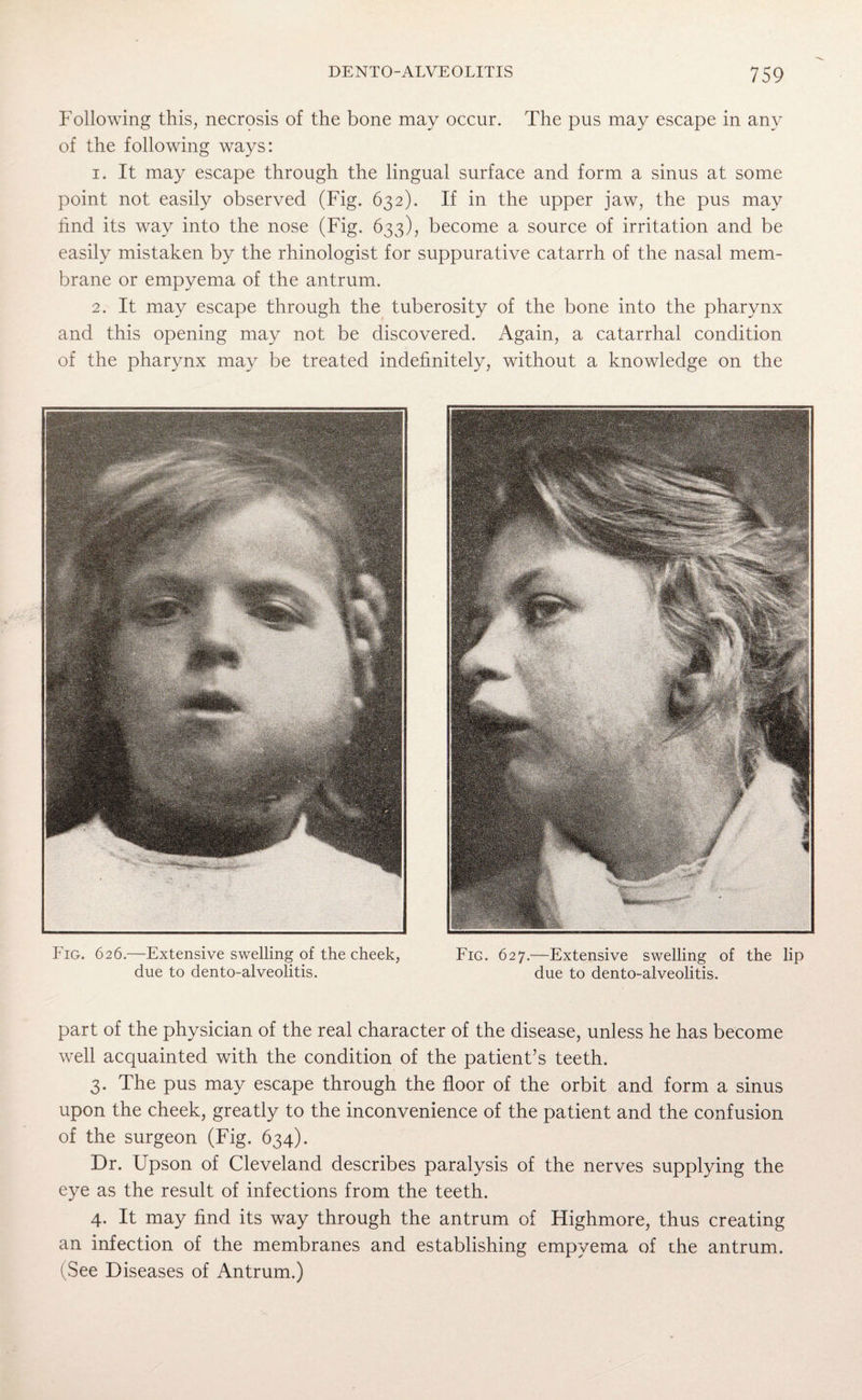 Following this, necrosis of the bone may occur. The pus may escape in any of the following ways: 1. It may escape through the lingual surface and form a sinus at some point not easily observed (Fig. 632). If in the upper jaw, the pus may find its way into the nose (Fig. 633), become a source of irritation and be easily mistaken by the rhinologist for suppurative catarrh of the nasal mem¬ brane or empyema of the antrum. 2. It may escape through the tuberosity of the bone into the pharynx and this opening may not be discovered. Again, a catarrhal condition of the pharynx may be treated indefinitely, without a knowledge on the Fig. 626.—Extensive swelling of the cheek, due to dento-alveolitis. Fig. 627.—Extensive swelling of the lip due to dento-alveolitis. part of the physician of the real character of the disease, unless he has become well acquainted with the condition of the patient’s teeth. 3. The pus may escape through the floor of the orbit and form a sinus upon the cheek, greatly to the inconvenience of the patient and the confusion of the surgeon (Fig. 634). Dr. Upson of Cleveland describes paralysis of the nerves supplying the eye as the result of infections from the teeth. 4. It may find its way through the antrum of Highmore, thus creating an infection of the membranes and establishing empyema of the antrum. (See Diseases of Antrum.)
