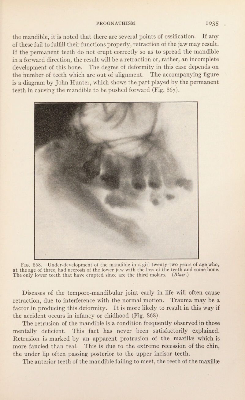 the mandible, it is noted that there are several points of ossification. If any of these fail to fulfill their functions properly, retraction of the jaw may result. If the permanent teeth do not erupt correctly so as to spread the mandible in a forward direction, the result will be a retraction or, rather, an incomplete development of this bone. The degree of deformity in this case depends on the number of teeth which are out of alignment. The accompanying figure is a diagram by John Hunter, which shows the part played by the permanent teeth in causing the mandible to be pushed forward (Fig. 867). Fig. 868.—Under-development of the mandible in a girl twenty-two years of age who, at the age of three, had necrosis of the lower jaw with the loss of the teeth and some bone. The only lower teeth that have erupted since are the third molars. {Blair.) Diseases of the temporo-mandibular joint early in life will often cause retraction, due to interference with the normal motion. Trauma may be a factor in producing this deformity. It is more likely to result in this way if the accident occurs in infancy or chidhood (Fig. 868). The retrusion of the mandible is a condition frequently observed in those mentally deficient. This fact has never been satisfactorily explained. Retrusion is marked by an apparent protrusion of the maxillae which is more fancied than real. This is due to the extreme recession of the chin, the under lip often passing posterior to the upper incisor teeth. The anterior teeth of the mandible failing to meet, the teeth of the maxillae