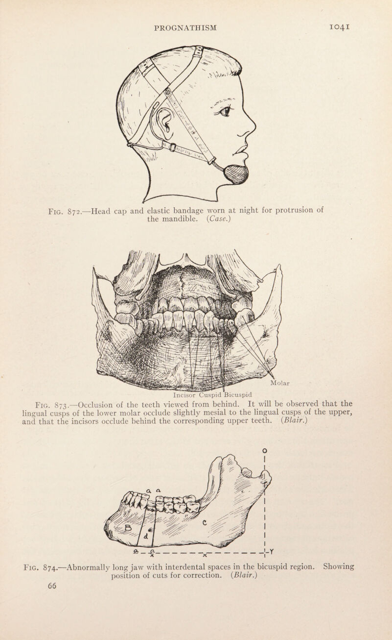 Fig. 872.—Head cap and elastic bandage worn at night for protrusion of the mandible. (Case.) Incisor Cuspid Bicuspid Fig. 873.—Occlusion of the teeth viewed from behind. It will be observed that the lingual cusps of the lower molar occlude slightly mesial to the lingual cusps of the upper, and that the incisors occlude behind the corresponding upper teeth. {Blair.) o Fig. 874.—Abnormally long jaw with interdental spaces in the bicuspid region. Showing position of cuts for correction. {Blair.) 66