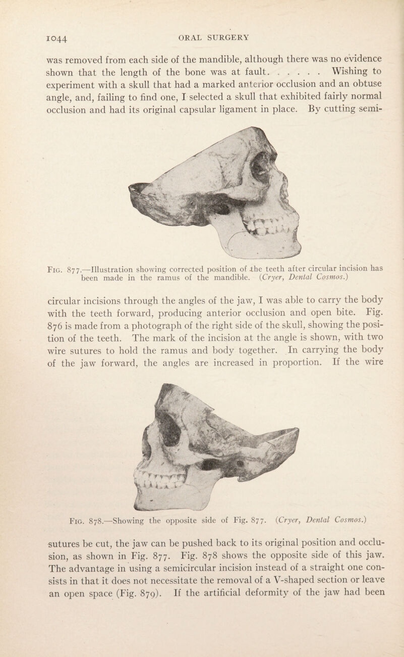 was removed from each side of the mandible, although there was no evidence shown that the length of the bone was at fault.Wishing to experiment with a skull that had a marked anterior occlusion and an obtuse angle, and, failing to find one, I selected a skull that exhibited fairly normal occlusion and had its original capsular ligament in place. By cutting semi- Fig. 877.—Illustration showing corrected position of -the teeth after circular incision has been made in the ramus of the mandible. (Cryer, Dental Cosmos.) circular incisions through the angles of the jaw, I was able to carry the body with the teeth forward, producing anterior occlusion and open bite. Fig. 876 is made from a photograph of the right side of the skull, showing the posi¬ tion of the teeth. The mark of the incision at the angle is shown, with two wire sutures to hold the ramus and body together. In carrying the body of the jaw forward, the angles are increased in proportion. If the wire Fig. 878.—Showing the opposite side of Fig. 877. {Cryer, Dental Cosmos.) sutures be cut, the jaw can be pushed back to its original position and occlu¬ sion, as shown in Fig. 877. Fig. 878 shows the opposite side of this jaw. The advantage in using a semicircular incision instead of a straight one con¬ sists in that it does not necessitate the removal of a V-shaped section or leave an open space (Fig. 879). If the artificial deformity of the jaw had been