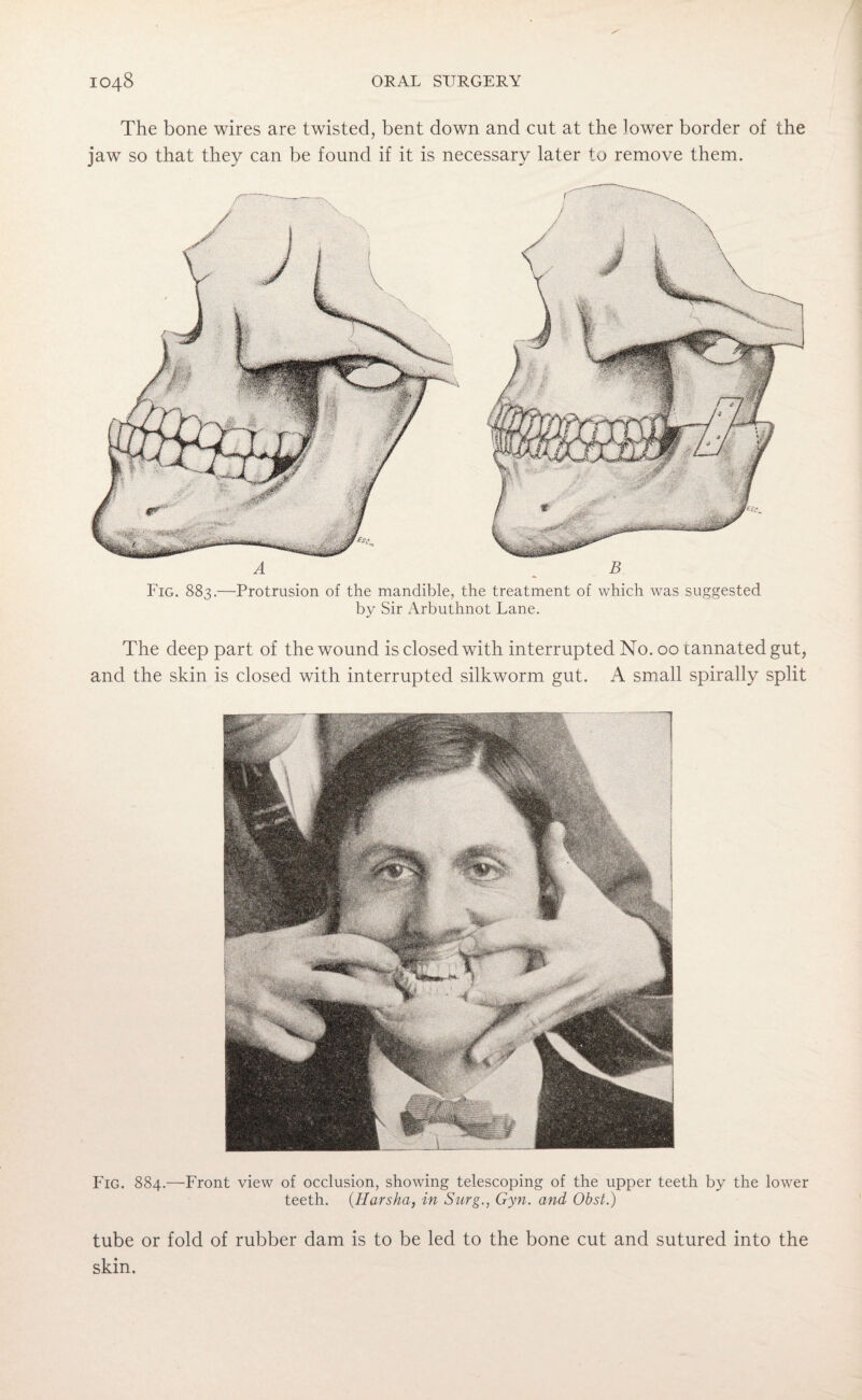 The bone wires are twisted, bent down and cut at the lower border of the jaw so that they can be found if it is necessary later to remove them. Fig. 883.—Protrusion of the mandible, the treatment of which was suggested by Sir Arbuthnot Lane. The deep part of the wound is closed with interrupted No. 00 tannated gut, and the skin is closed with interrupted silkworm gut. A small spirally split Fig. 884.—Front view of occlusion, showing telescoping of the upper teeth by the lower teeth. (Iiarsha, in Surg., Gyn. and Obst.) tube or fold of rubber dam is to be led to the bone cut and sutured into the skin.