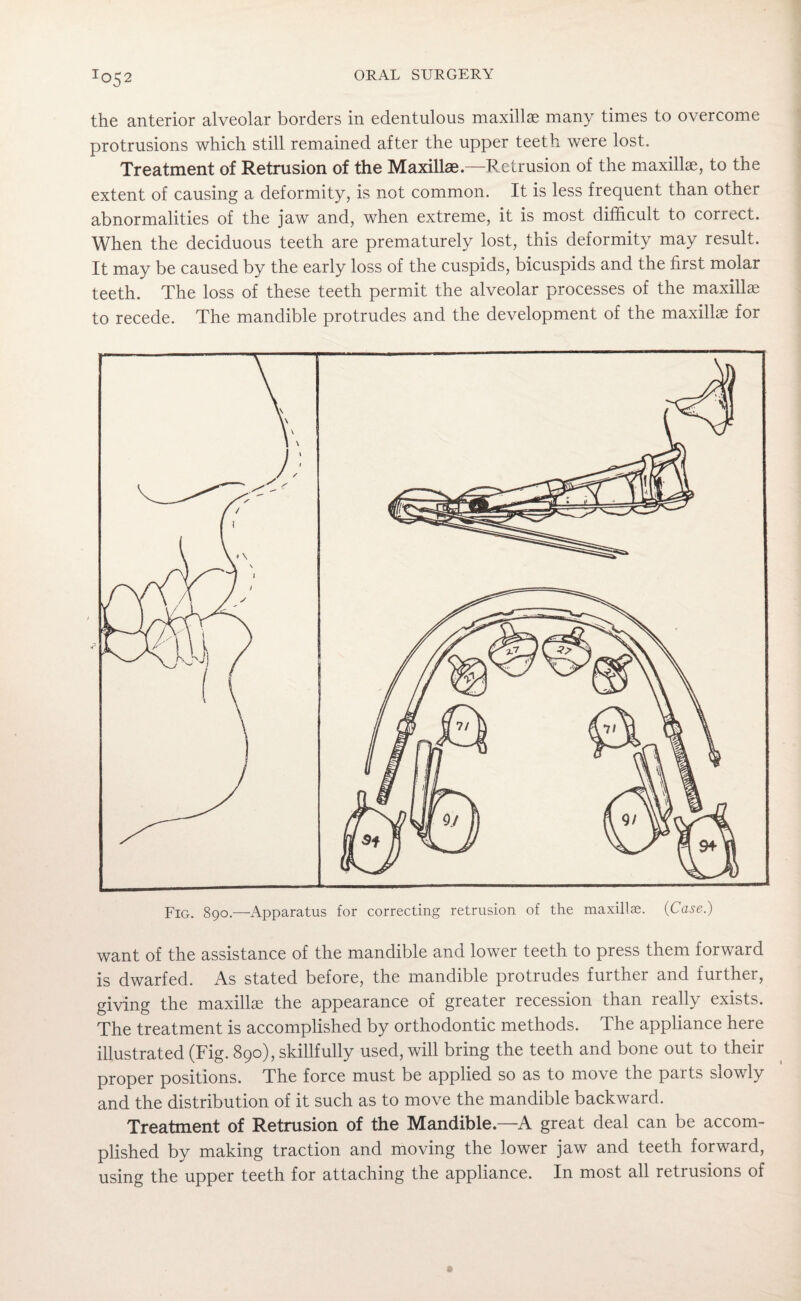 T°52 the anterior alveolar borders in edentulous maxillae many times to overcome protrusions which still remained after the upper teeth were lost. Treatment of Retrusion of the Maxillae.—Rctrusion of the maxillae, to the extent of causing a deformity, is not common. It is less frequent than other abnormalities of the jaw and, when extreme, it is most difficult to correct. When the deciduous teeth are prematurely lost, this deformity may result. It may be caused by the early loss of the cuspids, bicuspids and the first molar teeth. The loss of these teeth permit the alveolar processes of the maxillae to recede. The mandible protrudes and the development of the maxillae for Fig. 890.—Apparatus for correcting retrusion of the maxillae. (Case.) want of the assistance of the mandible and lower teeth to press them forward is dwarfed. As stated before, the mandible protrudes further and further, giving the maxillae the appearance of greater recession than really exists. The treatment is accomplished by orthodontic methods. The appliance here illustrated (Fig. 890), skillfully used, will bring the teeth and bone out to their proper positions. The force must be applied so as to move the parts slowly and the distribution of it such as to move the mandible backward. Treatment of Retrusion of the Mandible.—A great deal can be accom¬ plished by making traction and moving the lower jaw and teeth forward, using the upper teeth for attaching the appliance. In most all retrusions of