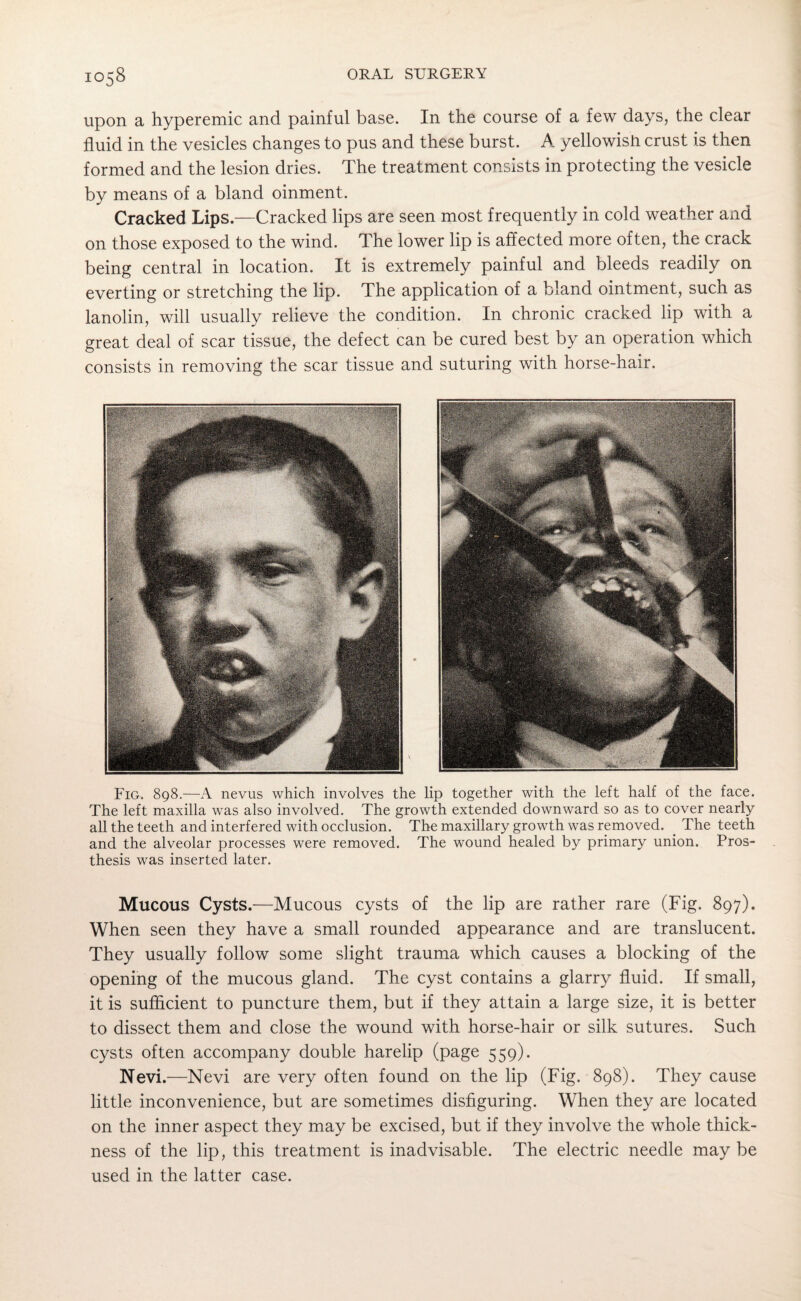 upon a hyperemic and painful base. In the course of a few days, the clear fluid in the vesicles changes to pus and these burst. A yellowish crust is then formed and the lesion dries. The treatment consists in protecting the vesicle by means of a bland oinment. Cracked Lips.—Cracked lips are seen most frequently in cold weather and on those exposed to the wind. The lower lip is affected more often, the crack being central in location. It is extremely painful and bleeds readily on everting or stretching the lip. The application of a bland ointment, such as lanolin, will usually relieve the condition. In chronic cracked lip with a great deal of scar tissue, the defect can be cured best by an operation which consists in removing the scar tissue and suturing with horse-hair. Fig. 898.—A nevus which involves the lip together with the left half of the face. The left maxilla was also involved. The growth extended downward so as to cover nearly all the teeth and interfered with occlusion. The maxillary growth was removed. . The teeth and the alveolar processes were removed. The wound healed by primary union. Pros¬ thesis was inserted later. Mucous Cysts.—Mucous cysts of the lip are rather rare (Fig. 897). When seen they have a small rounded appearance and are translucent. They usually follow some slight trauma which causes a blocking of the opening of the mucous gland. The cyst contains a glarry fluid. If small, it is sufficient to puncture them, but if they attain a large size, it is better to dissect them and close the wound with horse-hair or silk sutures. Such cysts often accompany double harelip (page 559). Nevi.—Nevi are very often found on the lip (Fig. 898). They cause little inconvenience, but are sometimes disfiguring. When they are located on the inner aspect they may be excised, but if they involve the whole thick¬ ness of the lip, this treatment is inadvisable. The electric needle may be used in the latter case.