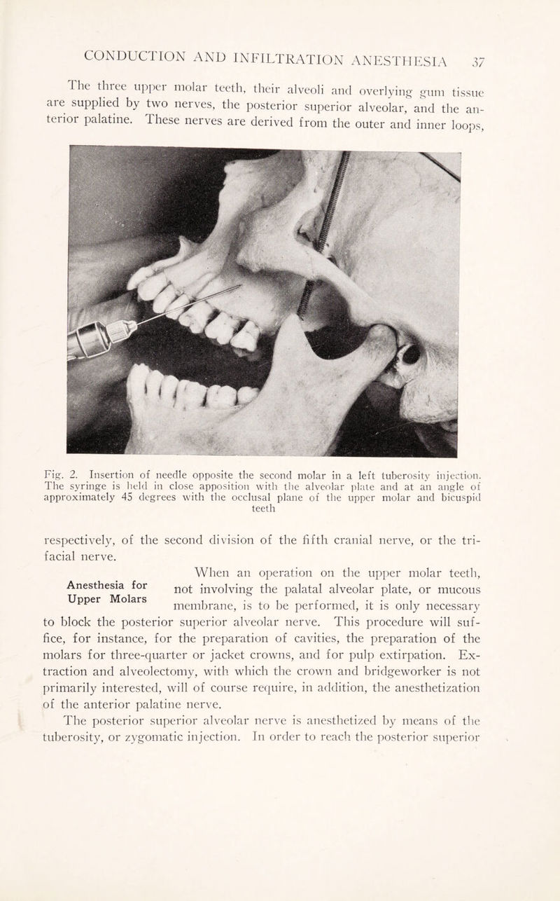 The three upper molar teeth, their alveoli and overlying gum tissue are supplied by two nerves, the posterior superior alveolar,' and the an- teiioi palatine. These nerves are derived from the outer and inner loop:'. Fig. 2. Insertion of needle opposite the second molar in a left tuberosity injection. The syringe is held in close apposition with the alveolar plate and at an angle of approximately 45 degrees with the occlusal plane of the upper molar and bicuspid teeth respectively, of the second division of the fifth cranial nerve, or the tri¬ facial nerve. When an operation on the upper molar teeth, Anesthesia for not jnvolving the palatal alveolar plate, or mucous Upper Molars , , r , • , membrane, is to be performed, it is only necessary to block the posterior superior alveolar nerve. This procedure will suf¬ fice, for instance, for the preparation of cavities, the preparation of the molars for three-quarter or jacket crowns, and for pulp extirpation. Ex¬ traction and alveolectomy, with which the crown and bridgeworker is not primarily interested, will of course require, in addition, the anesthetization of the anterior palatine nerve. The posterior superior alveolar nerve is anesthetized by means of the tuberosity, or zygomatic injection. In order to reach the posterior superior