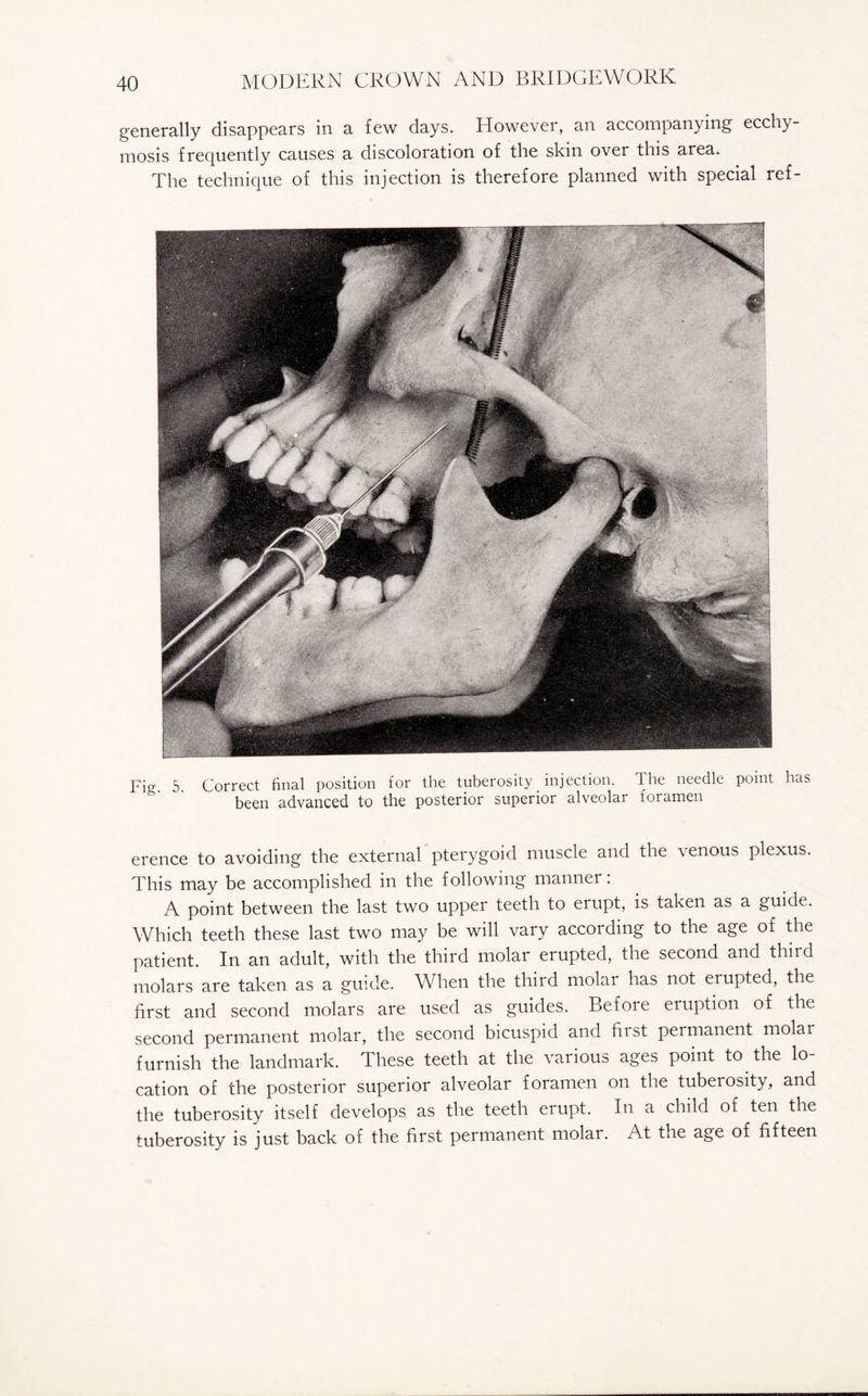 generally disappears in a few days. However, an accompanying ecchy- mosis frequently causes a discoloration of the skin over this area. The technique of this injection is therefore planned with special ref- Fio-. 5. Correct final position for the tuberosity injection. The needle point has been advanced to the posterior superior alveolar foramen erence to avoiding the external pterygoid muscle and the venous plexus. This may be accomplished in the following manner: A point between the last two upper teeth to erupt, is taken as a guide. Which teeth these last two may be will vary according to the age of the patient. In an adult, with the third molar erupted, the second and third molars are taken as a guide. When the third molar has not eiupted, the first and second molars are used as guides. Befoie eruption of the second permanent molar, the second bicuspid and hist permanent molar furnish the landmark. These teeth at the various ages point to the lo¬ cation of the posterior superior alveolar foramen on the tuberosity, and the tuberosity itself develops as the teeth erupt. In a child of ten the tuberosity is just back of the first permanent molar. At the age of fifteen