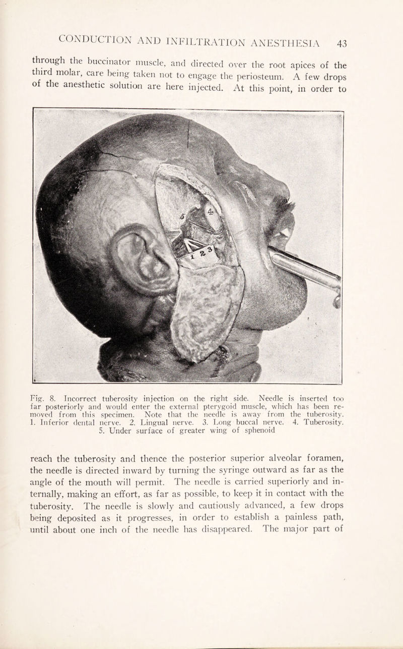 through the buccinator muscle, and directed over the root apices of the third molai, care being taken not to engage the periosteum. A few drops of the anesthetic solution are here injected. At this point, in order to Fig. 8. Incorrect tuberosity injection on the right side. Needle is inserted too far posteriorly and would enter the external pterygoid muscle, which has been re¬ moved from this specimen. Note that the needle is away from the tuberosity. 1. Inferior dental nerve. 2. Lingual nerve. 3. Long buccal nerve. 4. Tuberosity. 5. Under surface of greater wing of sphenoid reach the tuberosity and thence the posterior superior alveolar foramen, the needle is directed inward by turning the syringe outward as far as the angle of the mouth will permit. The needle is carried superiorly and in¬ ternally, making an effort, as far as possible, to keep it in contact with the tuberosity. The needle is slowly and cautiously advanced, a few drops being deposited as it progresses, in order to establish a painless path, until about one inch of the needle has disappeared. The major part of