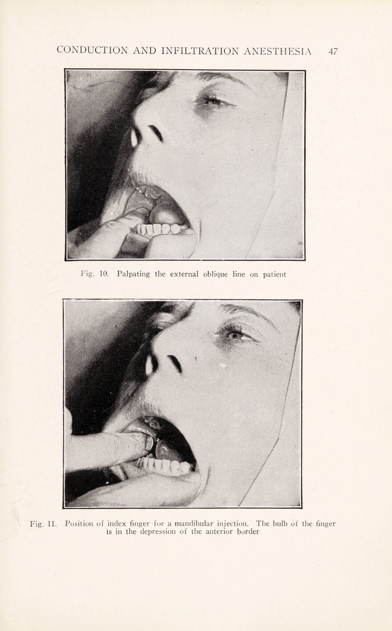Fig. 10. Palpating the external oblique line on patient Fig. 11. Position of index finger for a mandibular injection. The bulb of the finger is in the depression of the anterior border