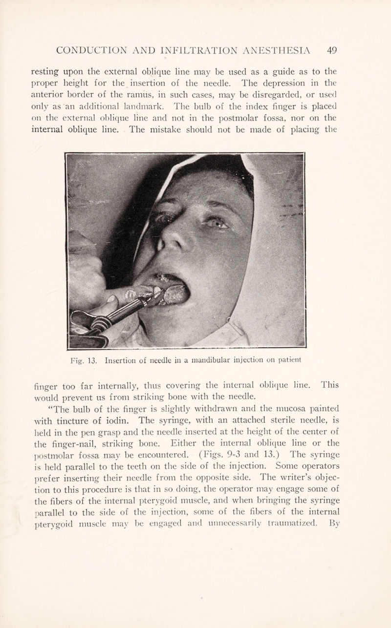 resting upon the external oblique line may be used as a guide as to the proper height for the insertion of the needle. The depression in the anterior border of the ramus, in such cases, may be disregarded, or used only as an additional landmark. The bulb of the index finger is placed on the external oblique line and not in the postmolar fossa, nor on the internal oblique line. The mistake should not be made of placing the Fig. 13. Insertion of needle in a mandibular injection on patient finger too far internally, thus covering the internal oblique line. This would prevent us from striking bone with the needle. “The bulb of the finger is slightly withdrawn and the mucosa painted with tincture of iodin. The syringe, with an attached sterile needle, is held in the pen grasp and the needle inserted at the height of the center of the finger-nail, striking bone. Either the internal oblique line or the postmolar fossa may be encountered. (Figs. 9-3 and 13.) The syringe is held parallel to the teeth on the side of the injection. Some operators prefer inserting their needle from the opposite side. The writer’s objec¬ tion to this procedure is that in so doing, the operator may engage some of the fibers of the internal pterygoid muscle, and when bringing the syringe parallel to the side of the injection, some of the fibers of the internal pterygoid muscle may be engaged and unnecessarily traumatized. By