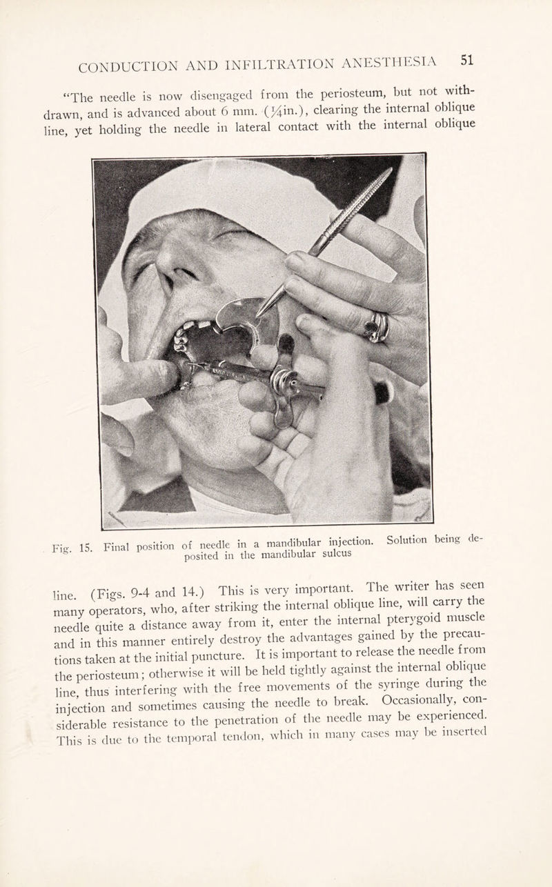 “The needle is now disengaged from the periosteum, but not with¬ drawn, and is advanced about 6 mm. (*4in.), clearing the internal oblique line, yet holding the needle in lateral contact with the internal oblique Fig. 15. Final position of needle in a mandibular injection. Solution being de posited in tlie mandibular sulcus line ('Fio'S. 9-4 and 14.) This is very important. The writer has seen many operators, who, after striking the internal oblique line, will carry tie needle quite a distance away from it, enter the internal pterygoid muscle and in this manner entirely destroy the advantages gained y t le precau tions taken at the initial puncture. It is important to release the needle from the periosteum; otherwise it will be held tightly against the internal oblique line thus interfering with the free movements of the syringe during the injection and sometimes causing the needle to break. Occasionally, con¬ siderable resistance to the penetration of the needle may be experienced This is due to the temporal tendon, which in many cases may be inserted