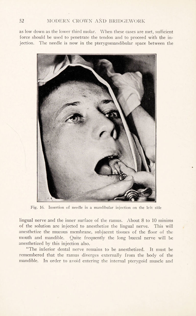 as low down as the lower third molar. When these cases are met, sufficient force should be used to penetrate the tendon and to proceed with the in¬ jection. The needle is now in the pterygomandibular space between the Fig. 16. Insertion of needle in a mandibular injection on the left side lingual nerve and the inner surface of the ramus. About 8 to 10 minims of the solution are injected to anesthetize the lingual nerve. This will anesthetize the mucous membrane, subjacent tissues of the floor of the mouth and mandible. Quite frequently the long buccal nerve will he anesthetized by this injection also. “The inferior dental nerve remains to be anesthetized. It must be remembered that the ramus diverges externally from the body of the mandible. In order to avoid entering the internal pterygoid muscle and