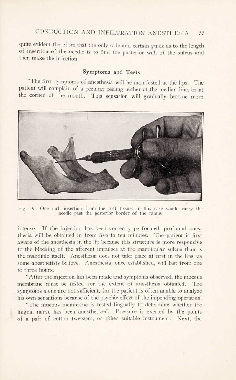 quite evident therefore that the only safe and certain guide as to the length of insertion of the needle is to find the posterior wall of the sulcus and then make the injection. Symptoms and Tests The first symptoms of anesthesia will be manifested at the lips. The patient will complain of a peculiar feeling, either at the median line, or at the corner of the mouth. T his sensation will gradually become more Fig. 19. One inch insertion from the soft tissues in this case would carry the needle past the posterior border of the ramus intense. If the injection has been correctly performed, profound anes¬ thesia will be obtained in from five to ten minutes. The patient is first aware of the anesthesia in the lip because this structure is more responsive to the blocking of the afferent impulses at the mandibular sulcus than is the mandible itself. Anesthesia does not take place at first in the lips, as some anesthetists believe. Anesthesia, once established, will last from one to three hours. ‘'After the injection has been made and symptoms observed, the mucous membrane must be tested for the extent of anesthesia obtained. The symptoms alone are not sufficient, for the patient is often unable to analyze his own sensations because of the psychic efifect of the impending operation. “The mucous membrane is tested lingually to determine whether the lingual nerve has been anesthetized. Pressure is exerted by the points of a pair of cotton tweezers, or other suitable instrument. Next, the