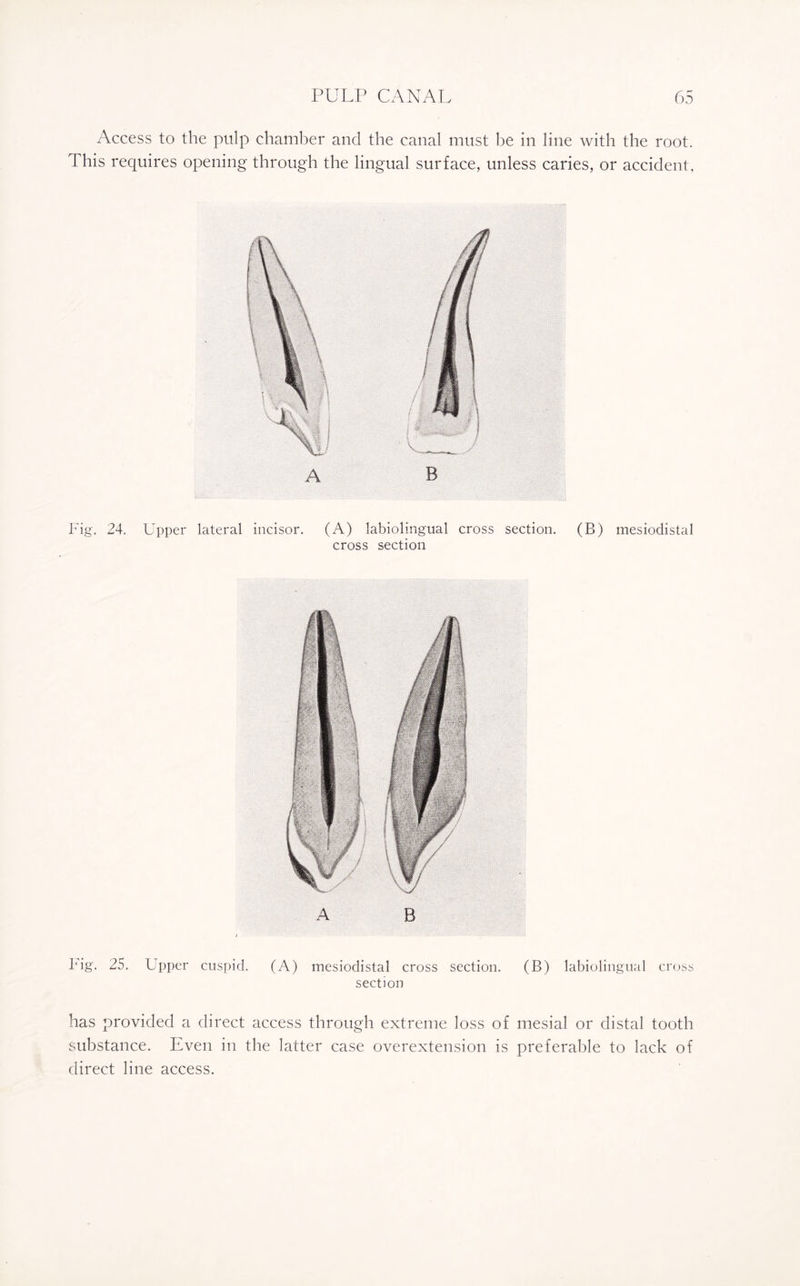 Access to the pulp chamber and the canal must be in line with the root. This requires opening through the lingual surface, unless caries, or accident, Fig. 24. Upper lateral incisor. (A) labiolingual cross section. (B) mesiodistal cross section lbg. 25. Upper cuspid. (A) mesiodistal cross section. (B) labiolingual cross section has provided a direct access through extreme loss of mesial or distal tooth substance. Even in the latter case overextension is preferable to lack of direct line access.