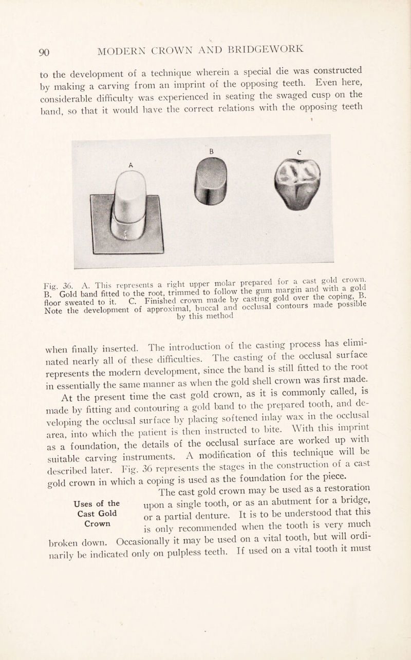 to the development of a technique wherein a special die was constructed by making a carving from an imprint of the opposing teeth. Even here, considerable difficulty was experienced in seating the swaged cusp on the band, so that it would have the correct relations with the opposing teeth Fig. 36. A. This represents a right upper molar prepared for a cast gold crown. B. Gold band fitted to the root, trimmed to follow the gum margin a ^ B floor sweated to it C. Finished crown made by casting gold over the C°P1^1 , Note ^^development of approximal, buccal and occlusal contours made possible bv this method when finally inserted. The introduction of the casting process has elimi¬ nated nearly all of these difficulties. The casting of the occlusal surface represents the modern development, since the band is still fitted to the loot in essentially the same manner as when the gold shell crown was first ma e. At the present time the cast gold crown, as it is commonly called is made by fitting and contouring a gold band to the prepared tooth, and de¬ veloping the occlusal surface by placing softened inlay wax in the occlusal area into which the patient is then instructed to bite. With this impim. as a foundation, the details of the occlusal surface are worked up with suitable carving instruments. A modification of this technique will be described later. Fig. 36 represents the stages m the construction of a cast o-old crown in which a coping is used as the foundation tor the piece. The cast gold crown may be used as a restoration Uses of the Up0n a single tooth, or as an abutment for a bridge, or a partial denture. It is to be understood that this is only recommended when the tooth is veiy much broken down. Occasionally it may be used on a vital tooth but will ordi¬ narily be indicated only on pulpless teeth. If used on a vital tooth it mus Cast Gold Crown