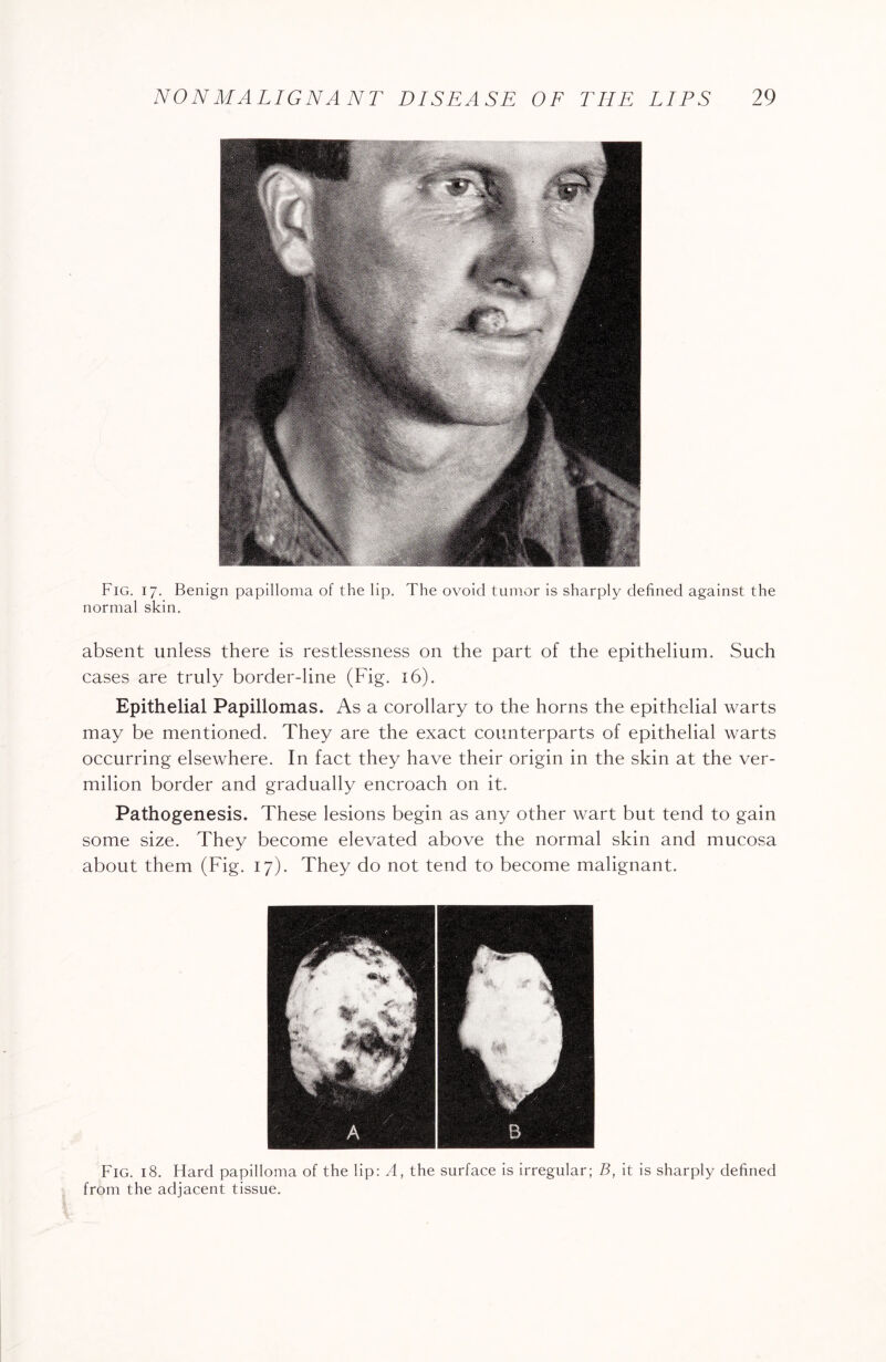 Fig. 17. Benign papilloma of the lip. The ovoid tumor is sharply defined against the normal skin. absent unless there is restlessness on the part of the epithelium. Such cases are truly border-line (Fig. 16). Epithelial Papillomas. As a corollary to the horns the epithelial warts may be mentioned. They are the exact counterparts of epithelial warts occurring elsewhere. In fact they have their origin in the skin at the ver¬ milion border and gradually encroach on it. Pathogenesis. These lesions begin as any other wart but tend to gain some size. They become elevated above the normal skin and mucosa about them (Fig. 17). They do not tend to become malignant. Fig. 18. Hard papilloma of the lip: A, the surface is irregular; B, it is sharply defined from the adjacent tissue.