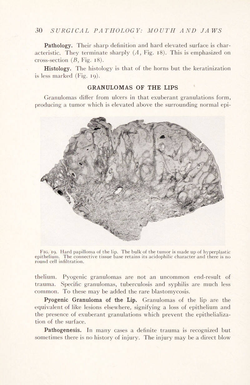 Pathology. Their sharp definition and hard elevated surface is char¬ acteristic. They terminate sharply (A, Fig. 18). This is emphasized on cross-section (B, Fig. 18). Histology. The histology is that of the horns but the keratinization is less marked (Fig. 19). GRANULOMAS OF THE LIPS Granulomas differ from ulcers in that exuberant granulations form, producing a tumor which is elevated above the surrounding normal epi- Fig. 19. Hard papilloma of the lip. The bulk of the tumor is made up of hyperplastic epithelium. The connective tissue base retains its acidophilic character and there is no round cell infiltration. thelium. Pyogenic granulomas are not an uncommon end-result of trauma. Specific granulomas, tuberculosis and syphilis are much less common. To these may be added the rare blastomycosis. Pyogenic Granuloma of the Lip. Granulomas of the lip are the equivalent of like lesions elsewhere, signifying a loss of epithelium and the presence of exuberant granulations which prevent the epithelializa- tion of the surface. Pathogenesis. In many cases a definite trauma is recognized but sometimes there is no history of injury. The injury may be a direct blow