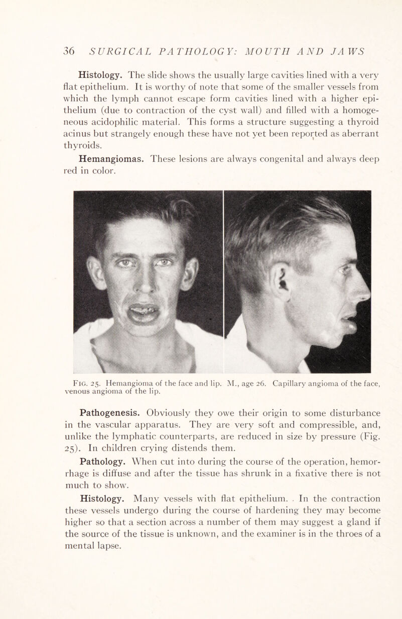 Histology. The slide shows the usually large cavities lined with a very flat epithelium. It is worthy of note that some of the smaller vessels from which the lymph cannot escape form cavities lined with a higher epi¬ thelium (due to contraction of the cyst wall) and filled with a homoge¬ neous acidophilic material. This forms a structure suggesting a thyroid acinus but strangely enough these have not yet been reported as aberrant thyroids. Hemangiomas. These lesions are always congenital and always deep red in color. Fig. 25. Hemangioma of the face and lip. M., age 26. Capillary angioma of the face, venous angioma of the lip. Pathogenesis. Obviously they owe their origin to some disturbance in the vascular apparatus. They are very soft and compressible, and, unlike the lymphatic counterparts, are reduced in size by pressure (Fig. 25). In children crying distends them. Pathology. When cut into during the course of the operation, hemor¬ rhage is diffuse and after the tissue has shrunk in a fixative there is not much to show. Histology. Many vessels with flat epithelium. . In the contraction these vessels undergo during the course of hardening they may become higher so that a section across a number of them may suggest a gland if the source of the tissue is unknown, and the examiner is in the throes of a mental lapse.