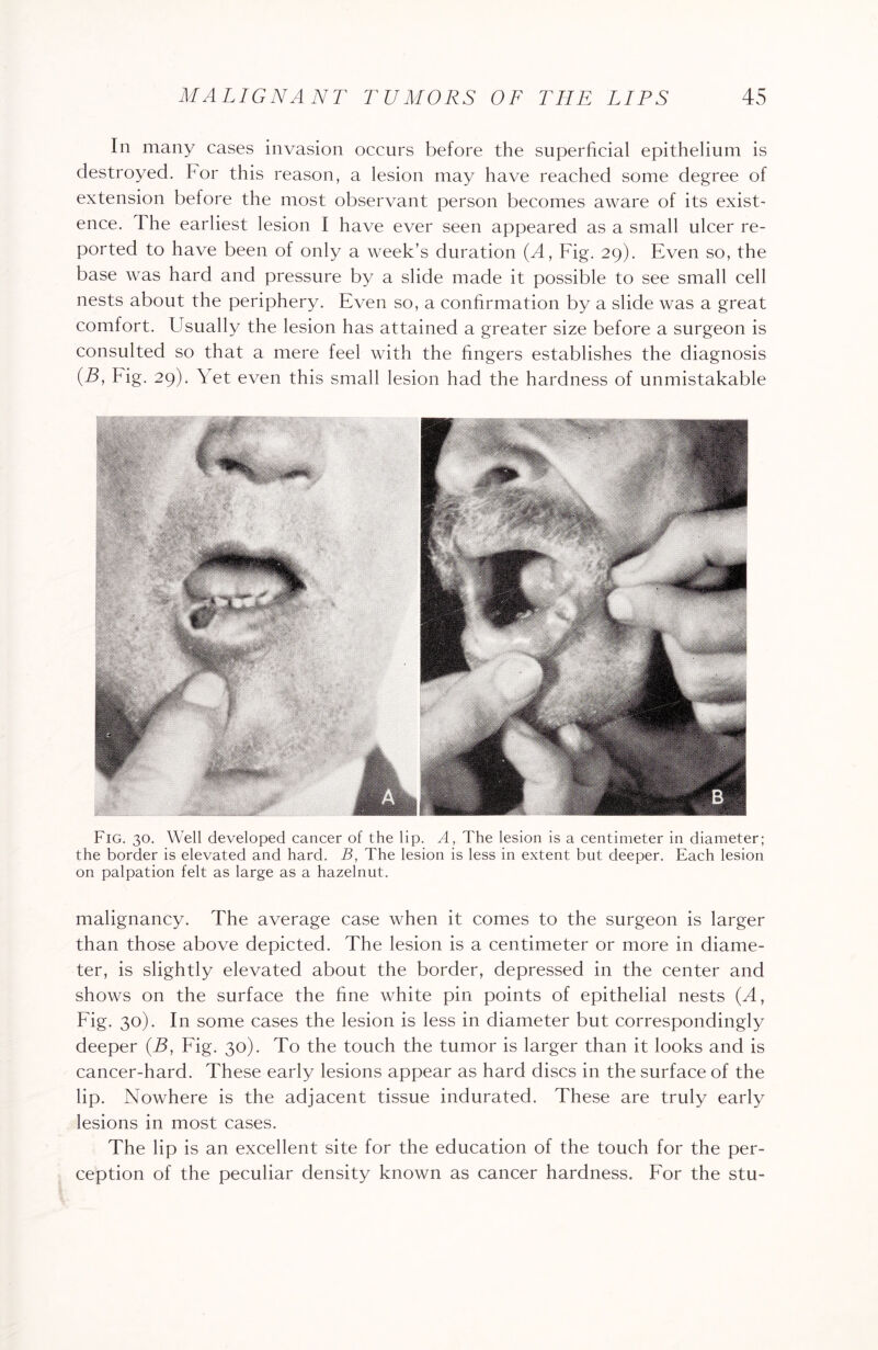 In many cases invasion occurs before the superficial epithelium is destroyed. For this reason, a lesion may have reached some degree of extension before the most observant person becomes aware of its exist¬ ence. The earliest lesion I have ever seen appeared as a small ulcer re¬ ported to have been of only a week’s duration (A, Fig. 29). Even so, the base was hard and pressure by a slide made it possible to see small cell nests about the periphery. Even so, a confirmation by a slide was a great comfort. Usually the lesion has attained a greater size before a surgeon is consulted so that a mere feel with the fingers establishes the diagnosis (B, Hg. 29). Yet even this small lesion had the hardness of unmistakable Fig. 30. Well developed cancer of the lip. A, The lesion is a centimeter in diameter; the border is elevated and hard. B, The lesion is less in extent but deeper. Each lesion on palpation felt as large as a hazelnut. malignancy. The average case when it comes to the surgeon is larger than those above depicted. The lesion is a centimeter or more in diame¬ ter, is slightly elevated about the border, depressed in the center and shows on the surface the fine white pin points of epithelial nests (A, Fig. 30). In some cases the lesion is less in diameter but correspondingly deeper (B, Fig. 30). To the touch the tumor is larger than it looks and is cancer-hard. These early lesions appear as hard discs in the surface of the lip. Nowhere is the adjacent tissue indurated. These are truly early lesions in most cases. The lip is an excellent site for the education of the touch for the per¬ ception of the peculiar density known as cancer hardness. For the stu-
