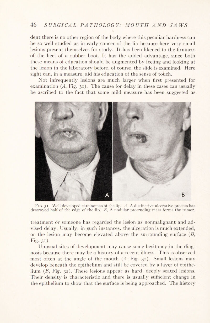 dent there is no other region of the body where this peculiar hardness can be so well studied as in early cancer of the lip because here very small lesions present themselves for study. It has been likened to the firmness of the heel of a rubber boot. It has the added advantage, since both these means of education should be augmented by feeling and looking at the lesion in the laboratory before, of course, the slide is examined. Here sight can, in a measure, aid his education of the sense of touch. Not infrequently lesions are much larger when first presented for examination (A, Fig. 31). The cause for delay in these cases can usually be ascribed to the fact that some mild measure has been suggested as Fig. 31. Well developed carcinomas of the lip. A, A distinctive ulcerative process has destroyed half of the edge of the lip. B, A nodular protruding mass forms the tumor. treatment or someone has regarded the lesion as nonmalignant and ad¬ vised delay. Usually, in such instances, the ulceration is much extended, or the lesion may become elevated above the surrounding surface (B, Fig. 31). Unusual sites of development may cause some hesitancy in the diag¬ nosis because there may be a history of a recent illness. This is observed most often at the angle of the mouth (4, Fig. 32). Small lesions may develop beneath the epithelium and still be covered by a layer of epithe¬ lium (By Fig. 32). These lesions appear as hard, deeply seated lesions. Their density is characteristic and there is usually sufficient change in the epithelium to show that the surface is being approached. The history