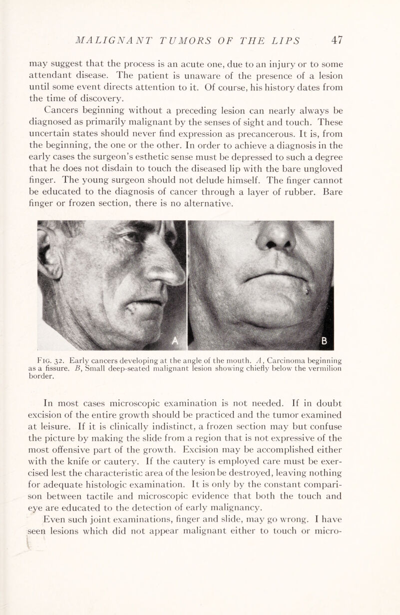 may suggest that the process is an acute one, due to an injury or to some attendant disease. The patient is unaware of the presence of a lesion until some event directs attention to it. Of course, his history dates from the time of discovery. Cancers beginning without a preceding lesion can nearly always be diagnosed as primarily malignant by the senses of sight and touch. These uncertain states should never find expression as precancerous. It is, from the beginning, the one or the other. In order to achieve a diagnosis in the early cases the surgeon’s esthetic sen.se must be depressed to such a degree that he does not disdain to touch the diseased lip with the bare ungloved finger. The young surgeon should not delude himself. The finger cannot be educated to the diagnosis of cancer through a layer of rubber. Bare finger or frozen section, there is no alternative. Fig. 32. Early cancers developing at the angle of the mouth. A, Carcinoma beginning as a fissure. B, Small deep-seated malignant lesion showing chiefly below the vermilion border. In most cases microscopic examination is not needed. If in doubt excision of the entire growth should be practiced and the tumor examined at leisure. If it is clinically indistinct, a frozen section may but confuse the picture by making the slide from a region that is not expressive of the most offensive part of the growth. Excision may be accomplished either with the knife or cautery. If the cautery is employed care must be exer¬ cised lest the characteristic area of the lesion be destroyed, leaving nothing for adequate histologic examination. It is only by the constant compari¬ son between tactile and microscopic evidence that both the touch and eye are educated to the detection of early malignancy. Even such joint examinations, finger and slide, may go wrong. I have seen lesions which did not appear malignant either to touch or micro-