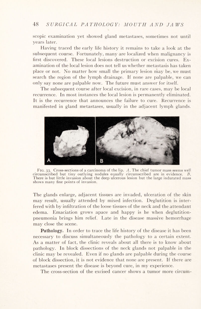 scopic examination yet showed gland metastases, sometimes not until years later. Having traced the early life history it remains to take a look at the subsequent course. Fortunately, many are localized when malignancy is first discovered. These local lesions destruction or excision cures. Ex¬ amination of the local lesion does not tell us whether metastasis has taken place or not. No matter how small the primary lesion may be, we must search the region of the lymph drainage. If none are palpable, we can only say none are palpable now. The future must answer for itself. The subsequent course after local excision, in rare cases, may be local recurrence. In most instances the local lesion is permanently eliminated. It is the recurrence that announces the failure to cure. Recurrence is manifested in gland metastases, usually in the adjacent lymph glands. Fig. 33. Cross-sections of a carcinoma of the lip. A, The chief tumor mass seems well circumscribed but tiny outlying nodules equally circumscribed are in evidence. B, There is but little invasion about the deep ulcerous lesion but the large indurated mass shows many fine points of invasion. The glands enlarge, adjacent tissues are invaded, ulceration of the skin may result, usually attended by mixed infection. Deglutition is inter¬ fered with by infiltration of the loose tissues of the neck and the attendant edema. Emaciation grows apace and happy is he when deglutition- pneumonia brings him relief. Late in the disease massive hemorrhage may close the scene. Pathology. In order to trace the life history of the disease it has been necessary to discuss simultaneously the pathology to a certain extent. As a matter of fact, the clinic reveals about all there is to know about pathology. In block dissections of the neck glands not palpable in the clinic may be revealed. Even if no glands are palpable during the course of block dissection, it is not evidence that none are present. If there are metastases present the disease is beyond cure, in my experience. The cross-section of the excised cancer shows a tumor more circum-