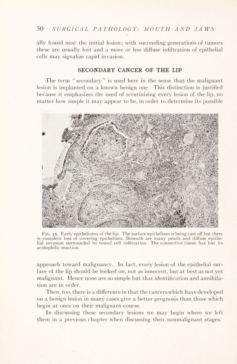 ally found near the initial lesion; with succeeding generations of tumors these are usually lost and a more or less diffuse infiltration of epithelial cells may signalize rapid invasion. SECONDARY CANCER OF THE LIP The term '‘secondary ” is used here in the sense that* the malignant lesion is implanted on a known benign one. This distinction is justified because it emphasizes the need of scrutinizing every lesion of the lip, no matter how simple it may appear to be, in order to determine its possible Fig. 35. Early epithelioma of the lip. The surface epithelium is being cast off but there is complete loss of covering epithelium. Beneath are many pearls and diffuse epithe¬ lial invasion surrounded by round cell infiltration. The connective tissue has lost its acidophilic reaction. approach toward malignancy. In fact, every lesion of the epithelial sur¬ face of the lip should be looked on, not as innocent, but at best as not yet malignant. Hence none are so simple but that identification and annihila¬ tion are in order. Then, too, there is a difference in that the cancers which have developed on a benign lesion in many cases give a better prognosis than those which begin at once on their malignant course. In discussing these secondary lesions we may begin where we left them in a previous chapter when discussing their nonmalignant stages.