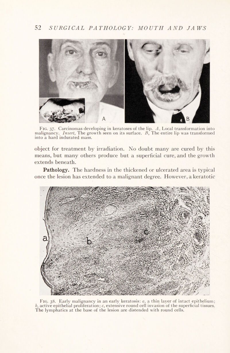 Fig. 37. Carcinomas developing in keratoses of the lip. A, Local transformation into malignancy. Insert, The growth seen on its surface. B, The entire lip was transformed into a hard indurated mass. object for treatment by irradiation. No doubt many are cured by this means, but many others produce but a superficial cure, and the growth extends beneath. Pathology. The hardness in the thickened or ulcerated area is typical once the lesion has extended to a malignant degree. However, a keratotic Fig. 38. Early malignancy in an early keratosis: a, a thin layer of intact epithelium; b, active epithelial proliferation; c, extensive round cell invasion of the superficial tissues. The lymphatics at the base of the lesion are distended with round cells.