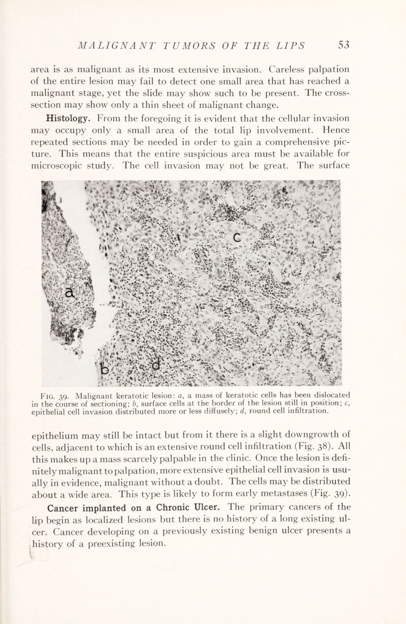 area is as malignant as its most extensive invasion. Careless palpation of the entire lesion may fail to detect one small area that has reached a malignant stage, yet the slide may show such to be present. The cross- section may show only a thin sheet of malignant change. Histology. From the foregoing it is evident that the cellular invasion may occupy only a small area of the total lip involvement. Hence repeated sections may be needed in order to gain a comprehensive pic¬ ture. This means that the entire suspicious area must be available for microscopic study. The cell invasion may not be great. The surface Fig. 39. Malignant keratotic lesion: a, a mass of keratotic cells has been dislocated in the course of sectioning; b, surface cells at the border of the lesion still in position; c, epithelial cell invasion distributed more or less diffusely; d, round cell infiltration. epithelium may still be intact but from it there is a slight downgrowth of cells, adjacent to which is an extensive round cell infiltration (Fig. 38). All this makes up a mass scarcely palpable in the clinic. Once the lesion is defi¬ nitely malignant to palpation, more extensive epithelial cell invasion is usu¬ ally in evidence, malignant without a doubt. The cells may be distributed about a wide area. This type is likely to form early metastases (Fig. 39). Cancer implanted on a Chronic Ulcer. The primary cancers of the lip begin as localized lesions but there is no history of a long existing ul¬ cer. Cancer developing on a previously existing benign ulcer presents a history of a preexisting lesion.