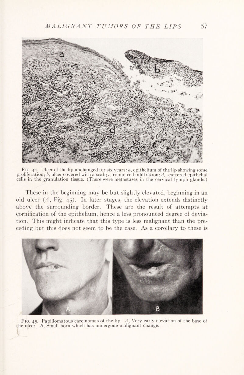 Fig. 44. Ulcer of the lip unchanged for six years: a, epithelium of the lip showing some proliferation; b, ulcer covered with a scab; c, round cell infiltration; d, scattered epithelial cells in the granulation tissue. (There were metastases in the cervical lymph glands.) These in the beginning may be but slightly elevated, beginning in an old ulcer (A, Fig. 45). In later stages, the elevation extends distinctly above the surrounding border. These are the result of attempts at cornification of the epithelium, hence a less pronounced degree of devia¬ tion. This might indicate that this type is less malignant than the pre¬ ceding but this does not seem to be the case. As a corollary to these is Fig. 45. Papillomatous carcinomas of the lip. A, Very early elevation of the base of the ulcer. B, Small horn which has undergone malignant change.