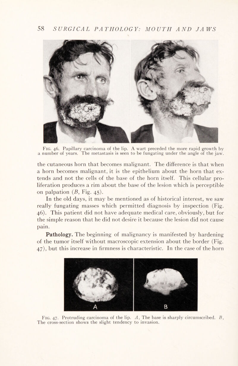 Fig. 46. Papillary carcinoma of the lip. A wart preceded the more rapid growth by a number of years. The metastasis is seen to be fungating under the angle of the jaw. the cutaneous horn that becomes malignant. The difference is that when a horn becomes malignant, it is the epithelium about the horn that ex¬ tends and not the cells of the base of the horn itself. This cellular pro¬ liferation produces a rim about the base of the lesion which is perceptible on palpation (B, Fig. 45). In the old days, it may be mentioned as of historical interest, we saw really fungating masses which permitted diagnosis by inspection (Fig. 46) . This patient did not have adequate medical care, obviously, but for the simple reason that he did not desire it because the lesion did not cause pain. Pathology. The beginning of malignancy is manifested by hardening of the tumor itself without macroscopic extension about the border (Fig. 47) , but this increase in firmness is characteristic. In the case of the horn Fig. 47. Protruding carcinoma of the lip. A, The base is sharply circumscribed. B, The cross-section shows the slight tendency to invasion.